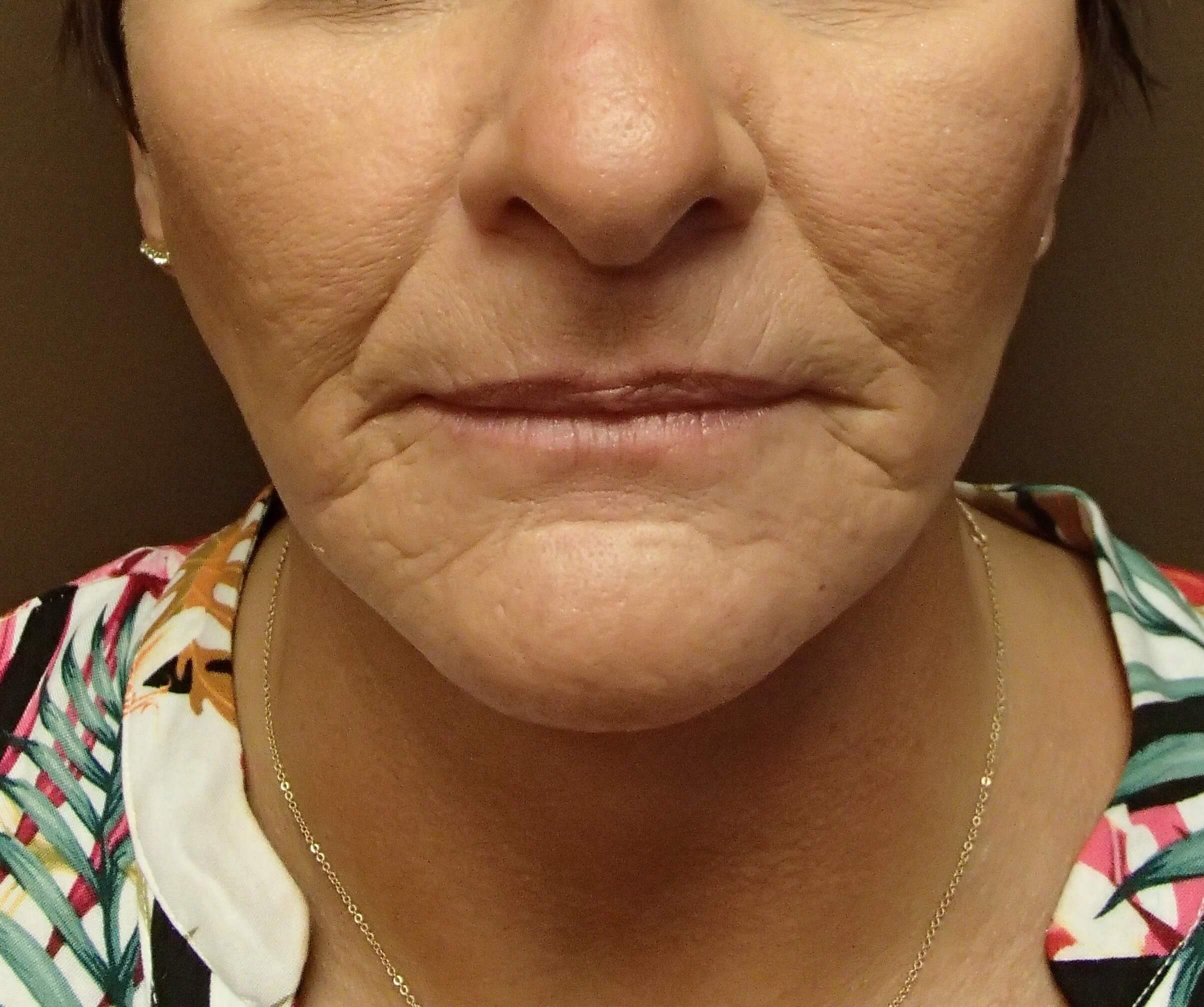 Necklift After