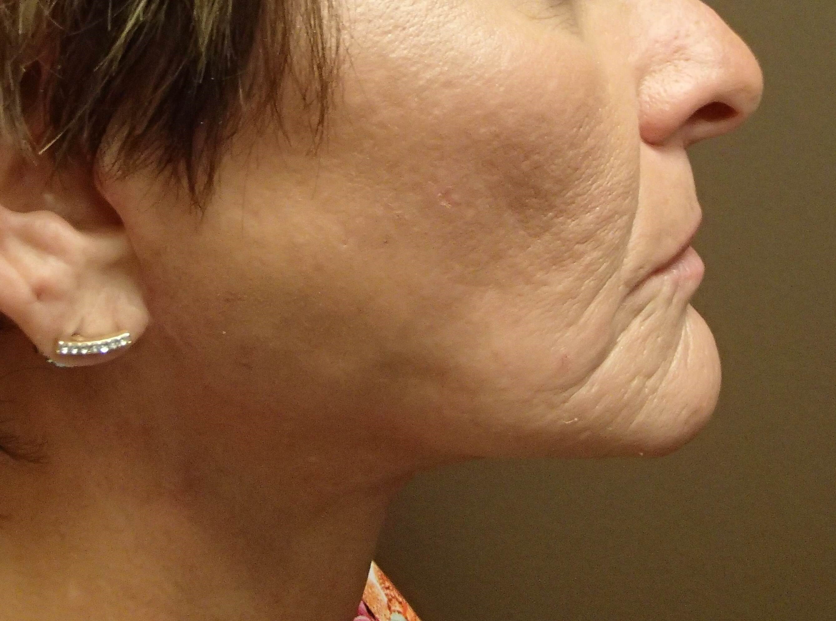 Necklift After