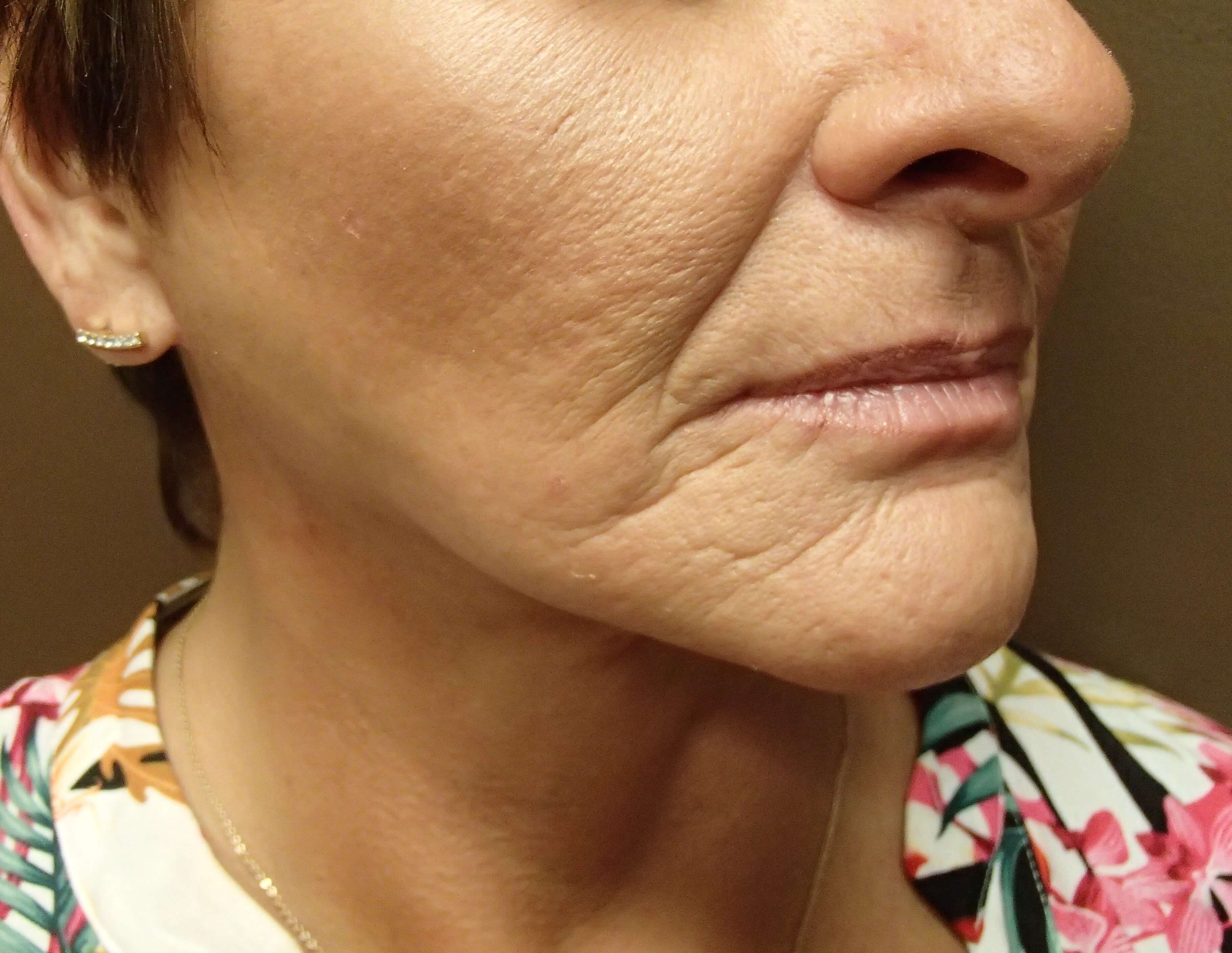Necklift After