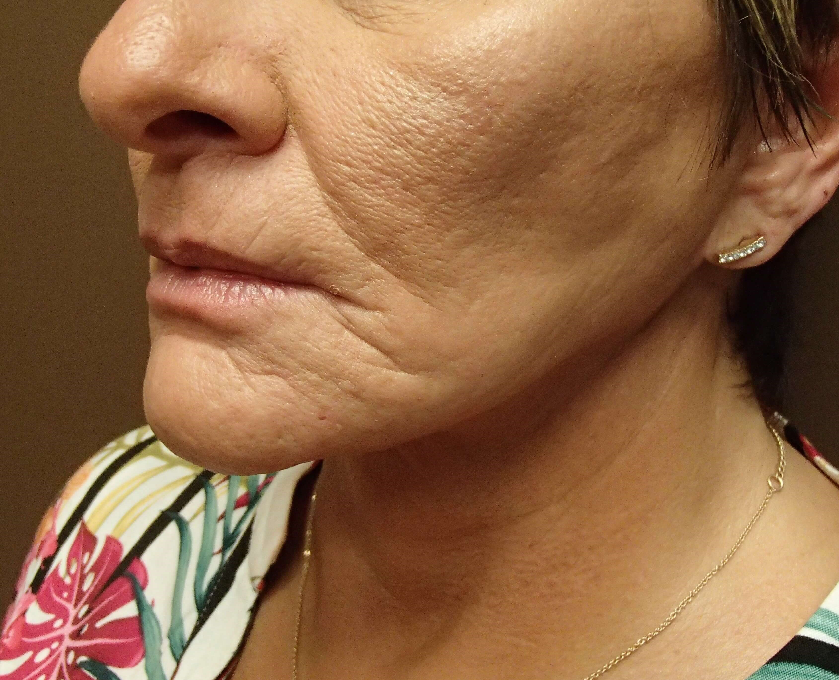 Necklift After