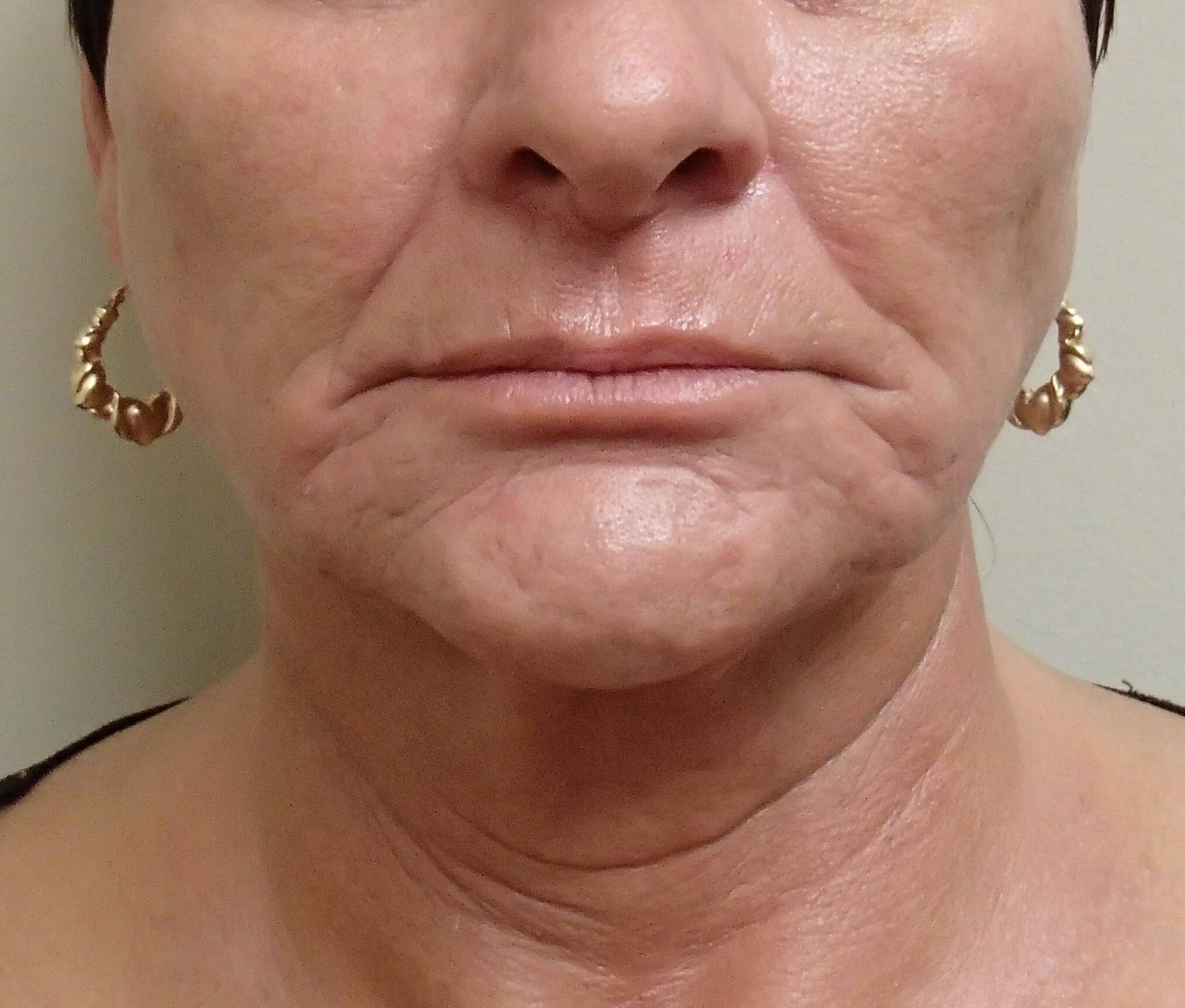Necklift Before