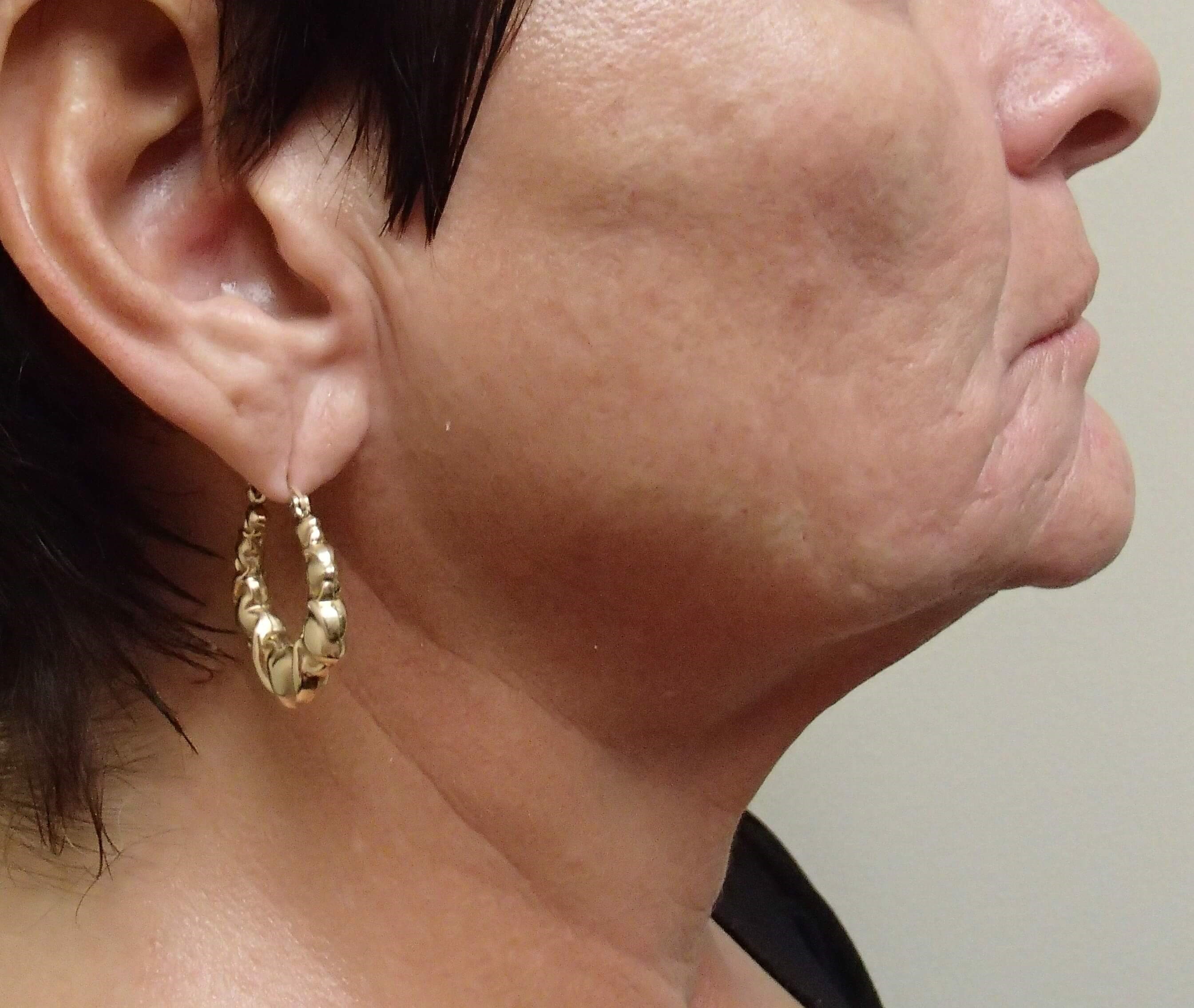 Necklift Before