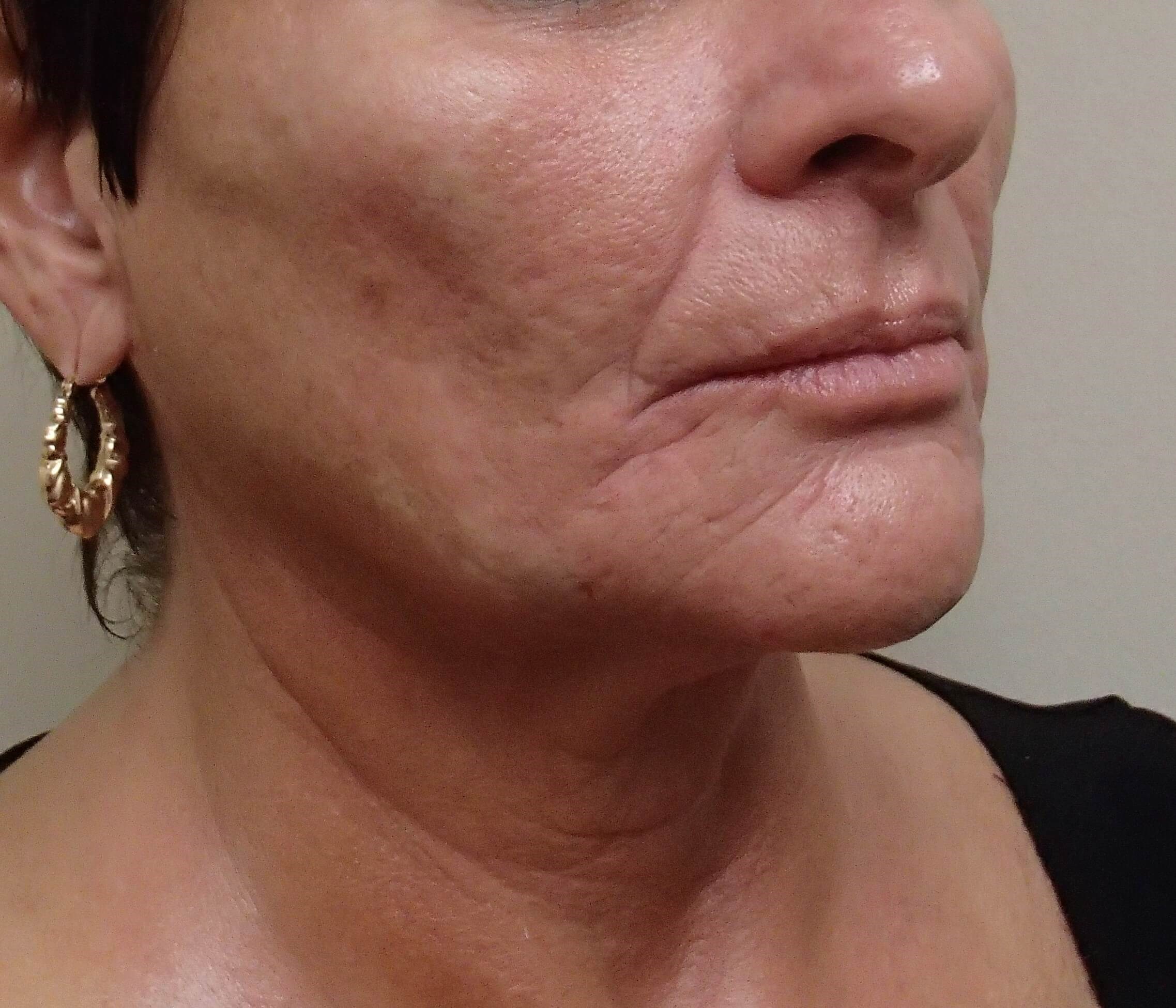 Necklift Before