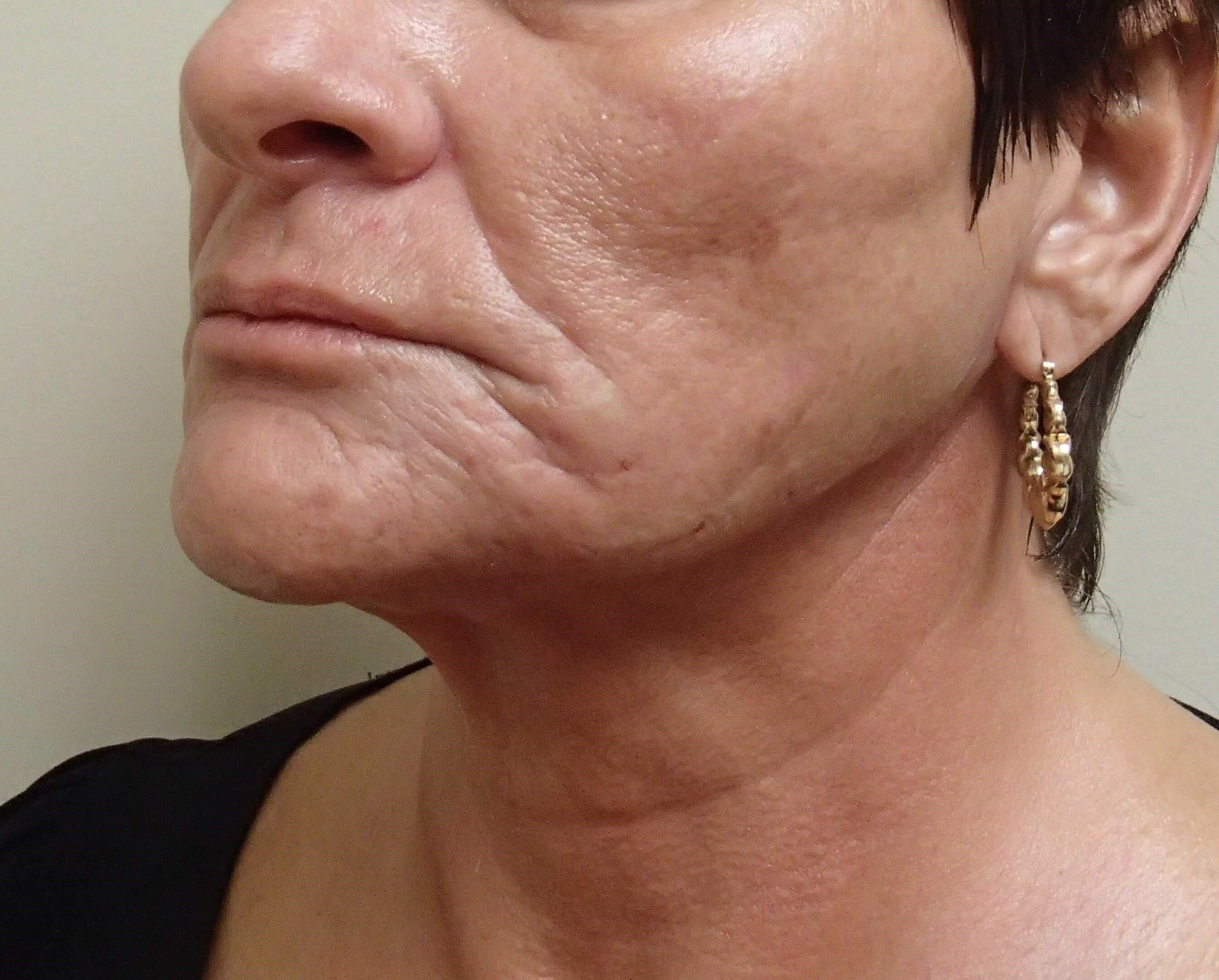 Necklift Before