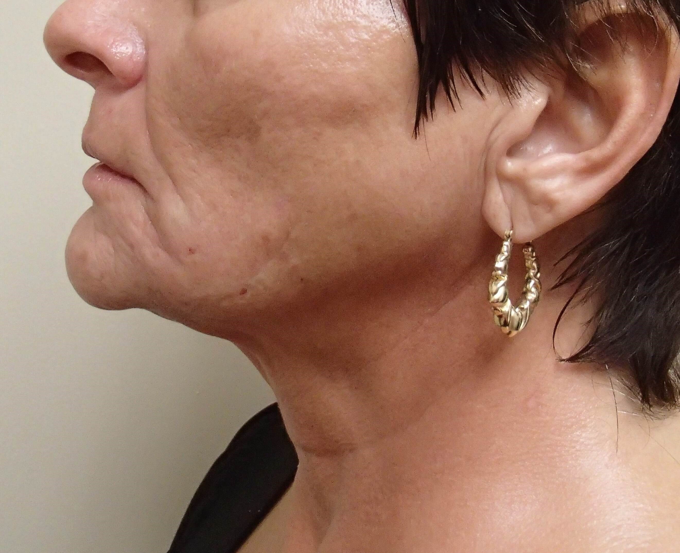 Necklift Before