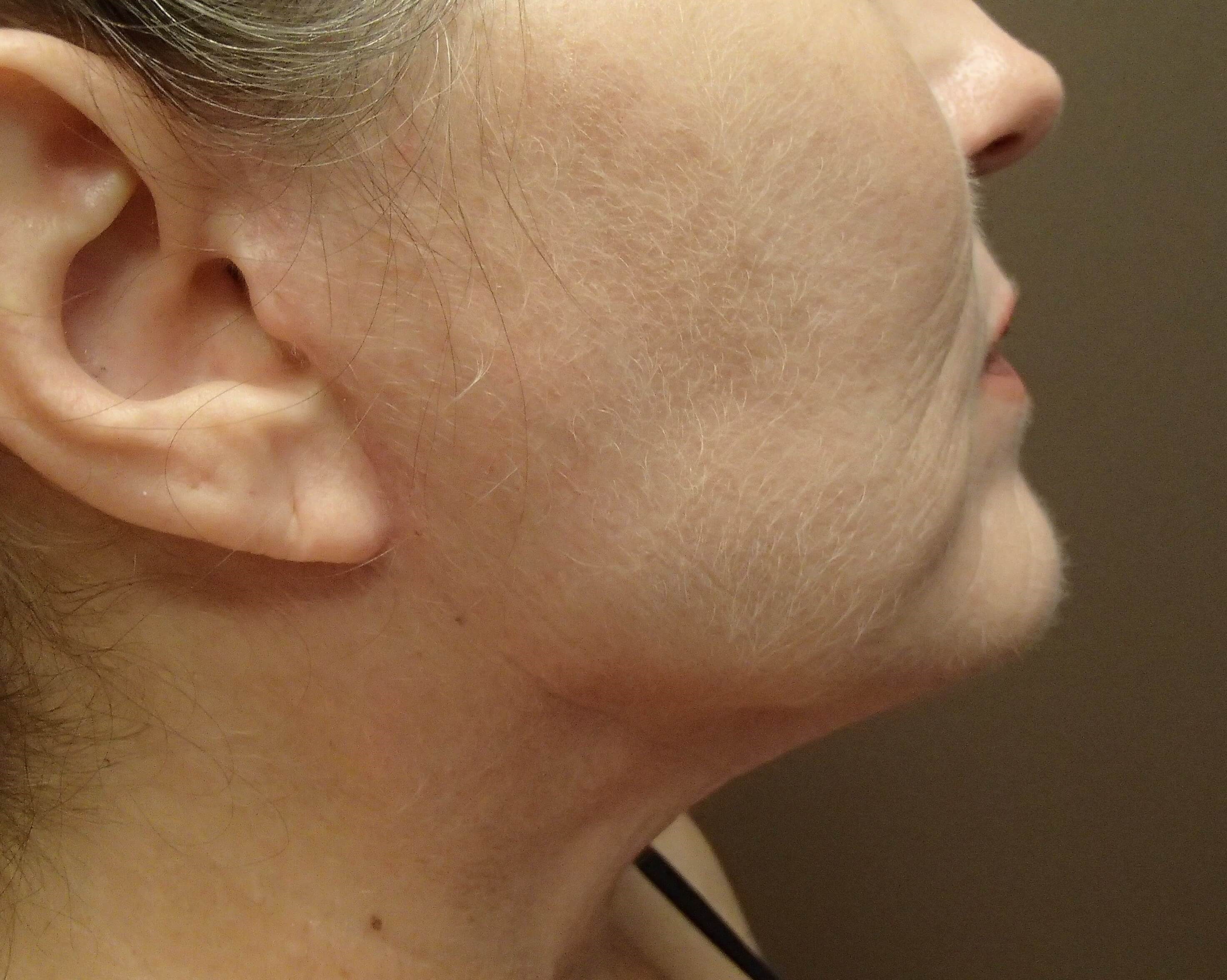 Necklift After
