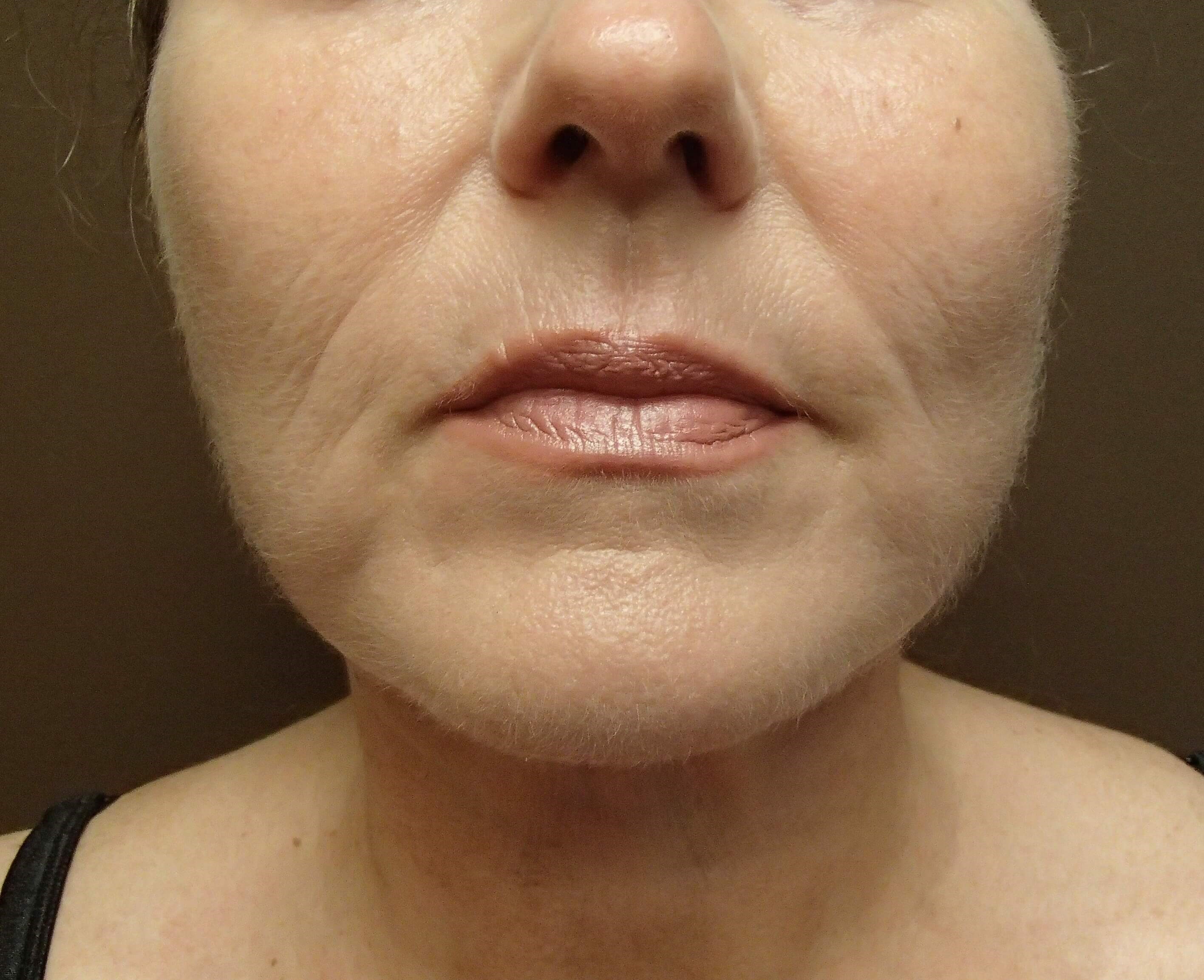 Necklift After