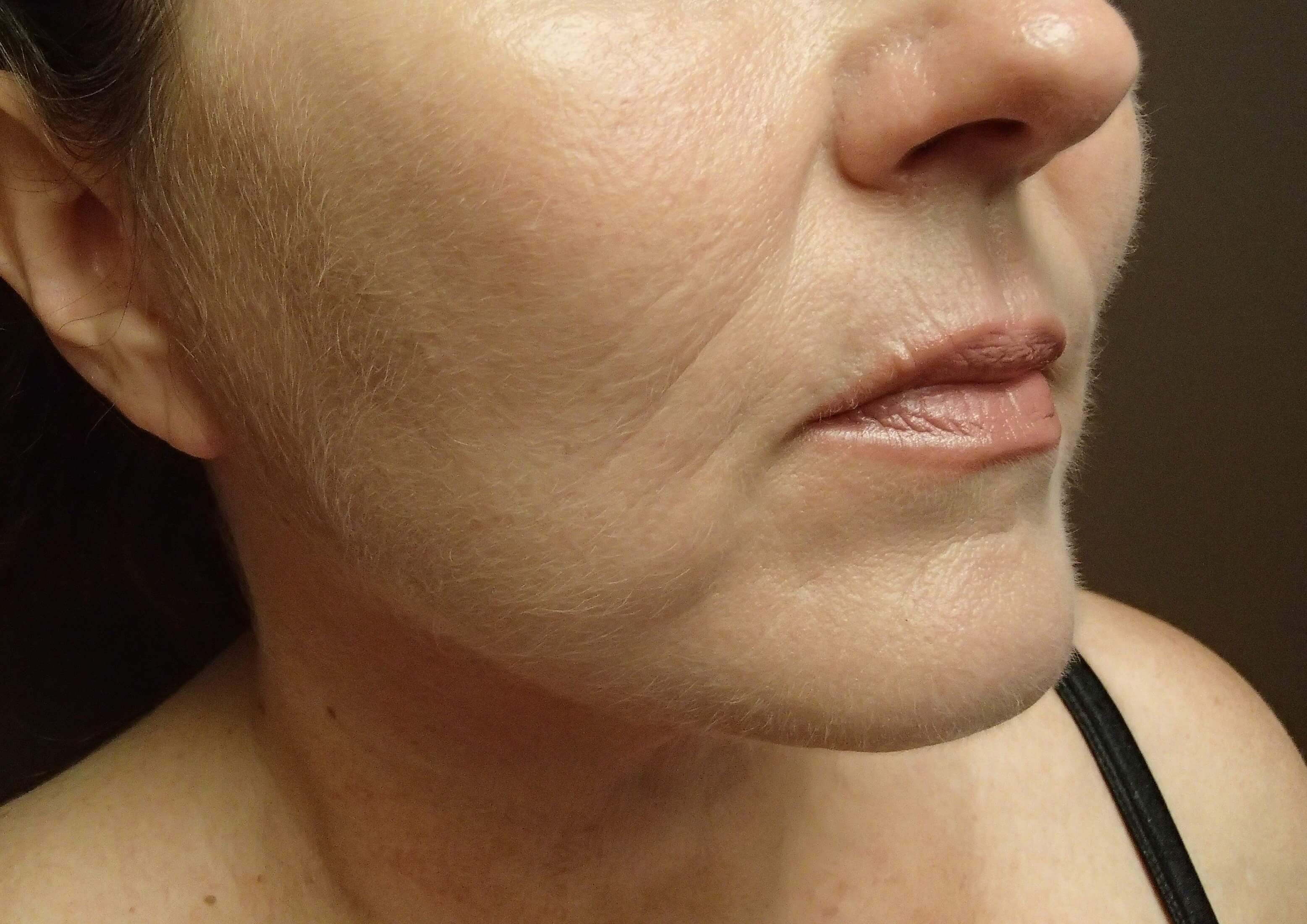 Necklift After
