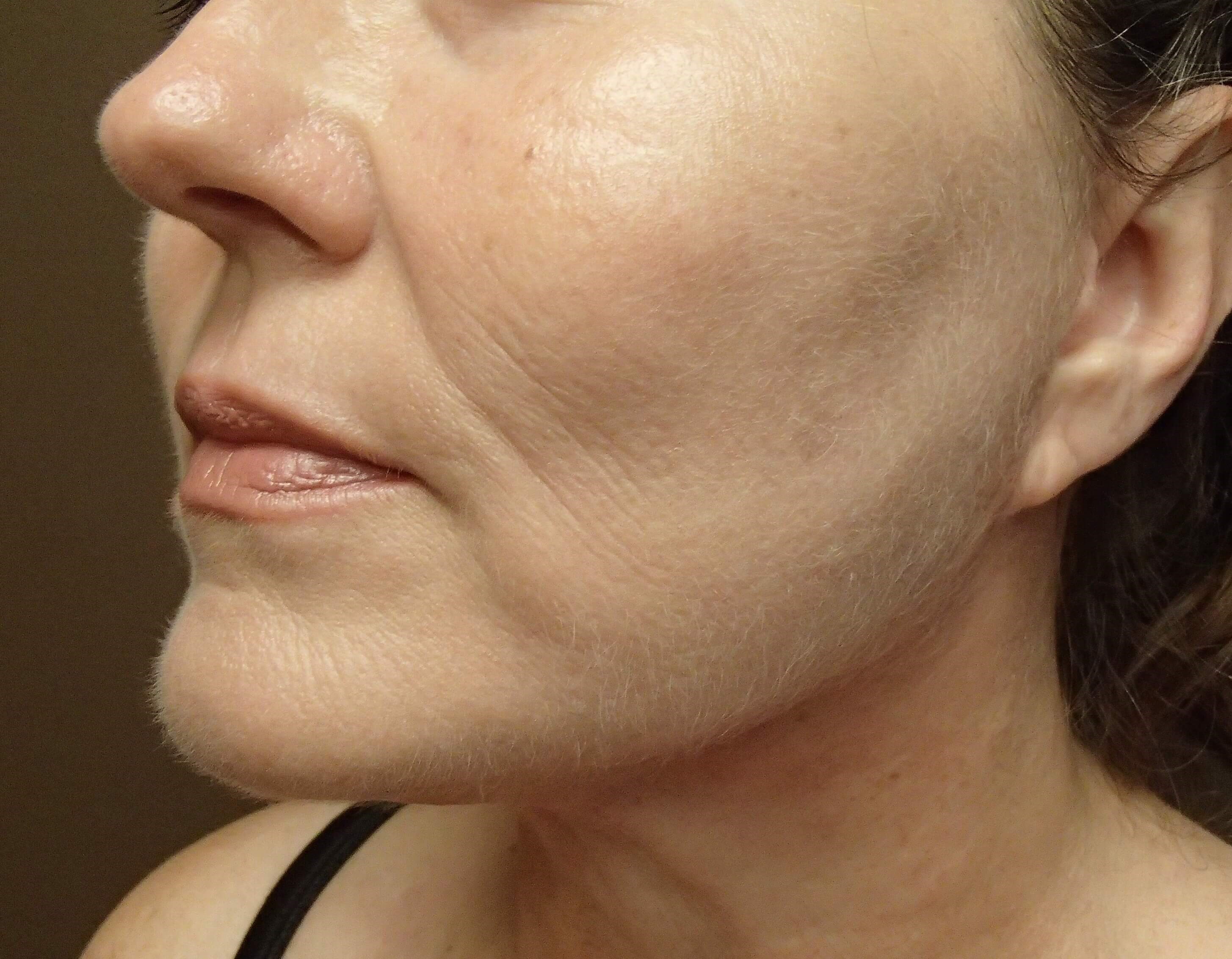 Necklift After