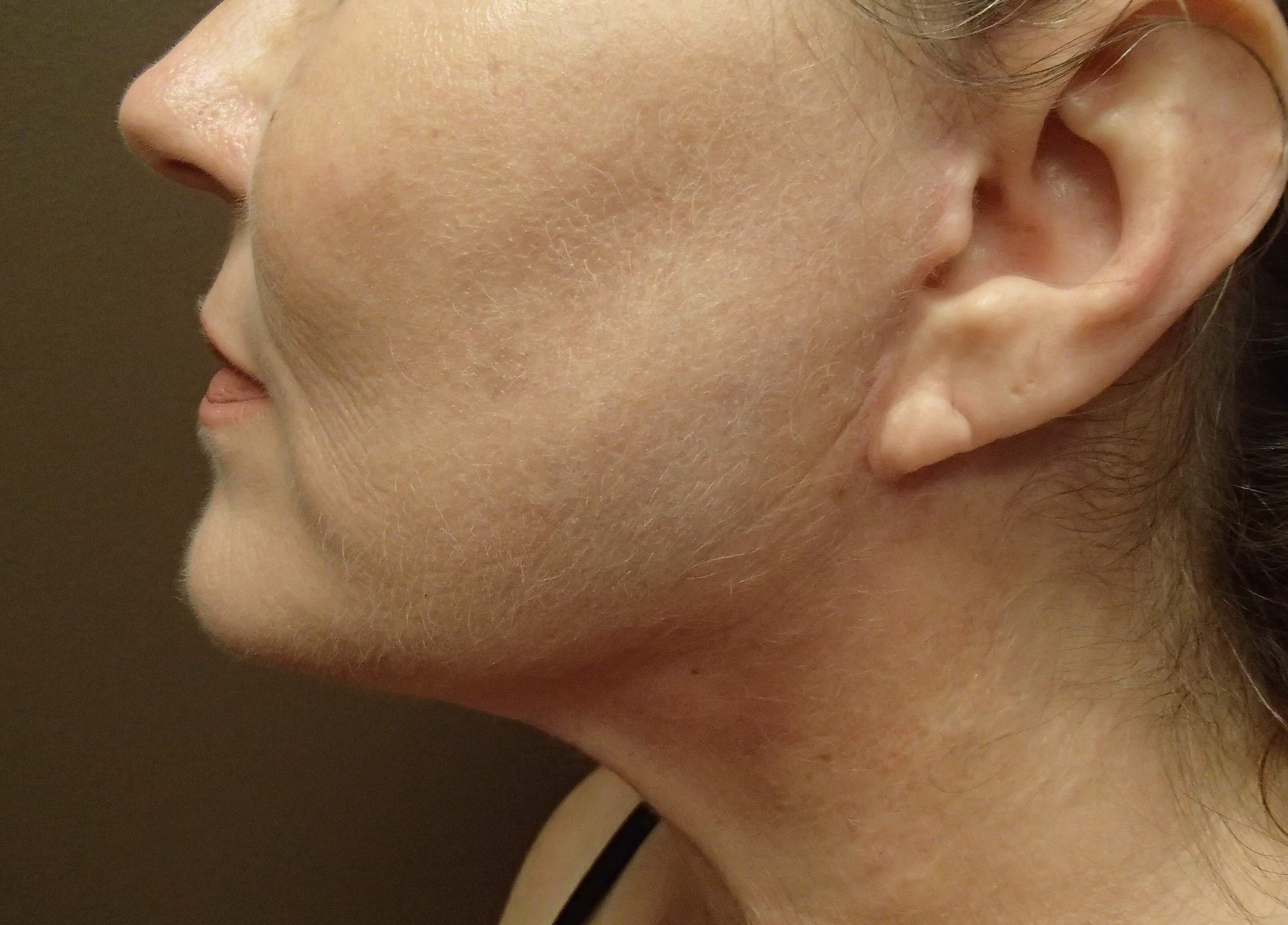 Necklift After