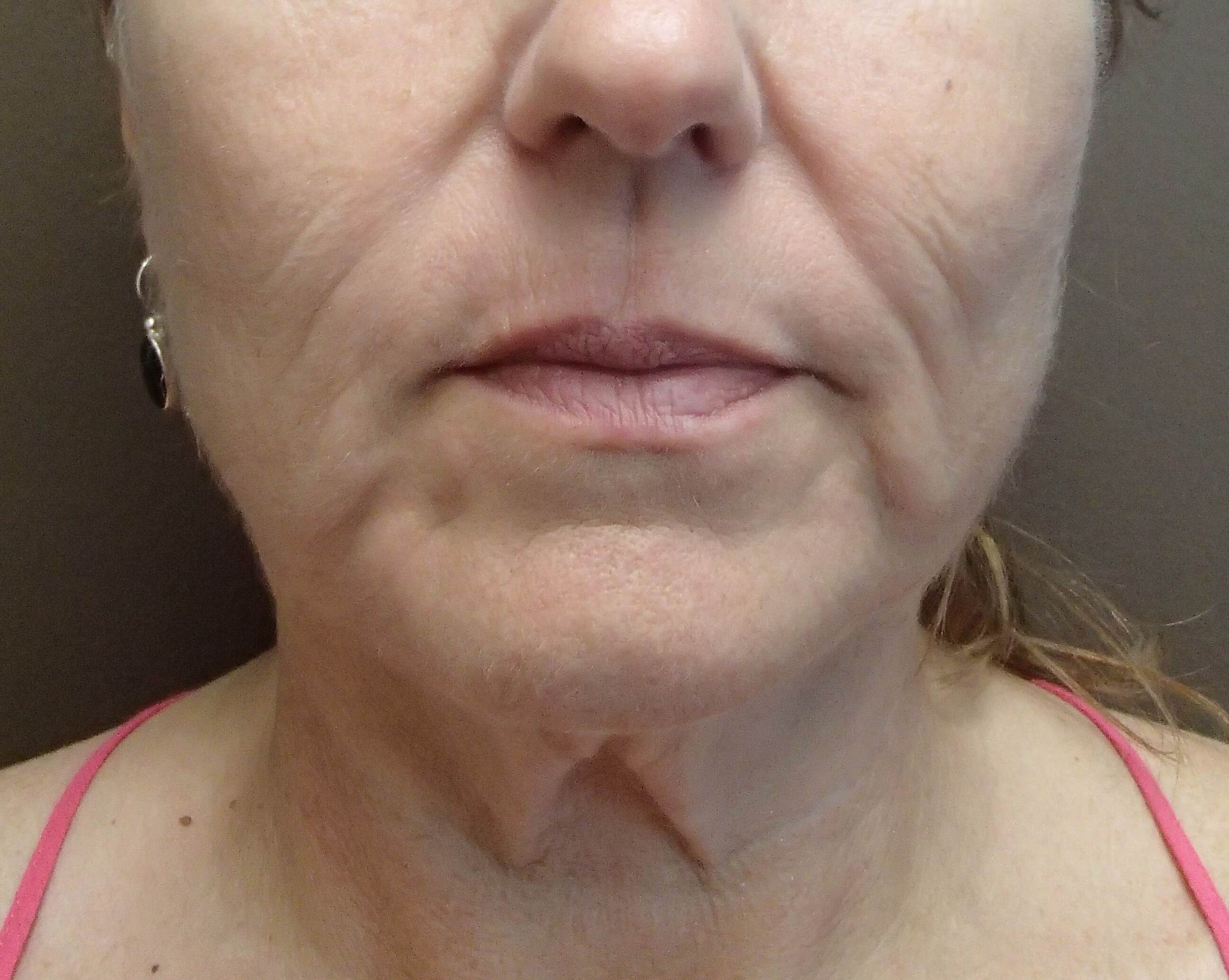 Necklift Before