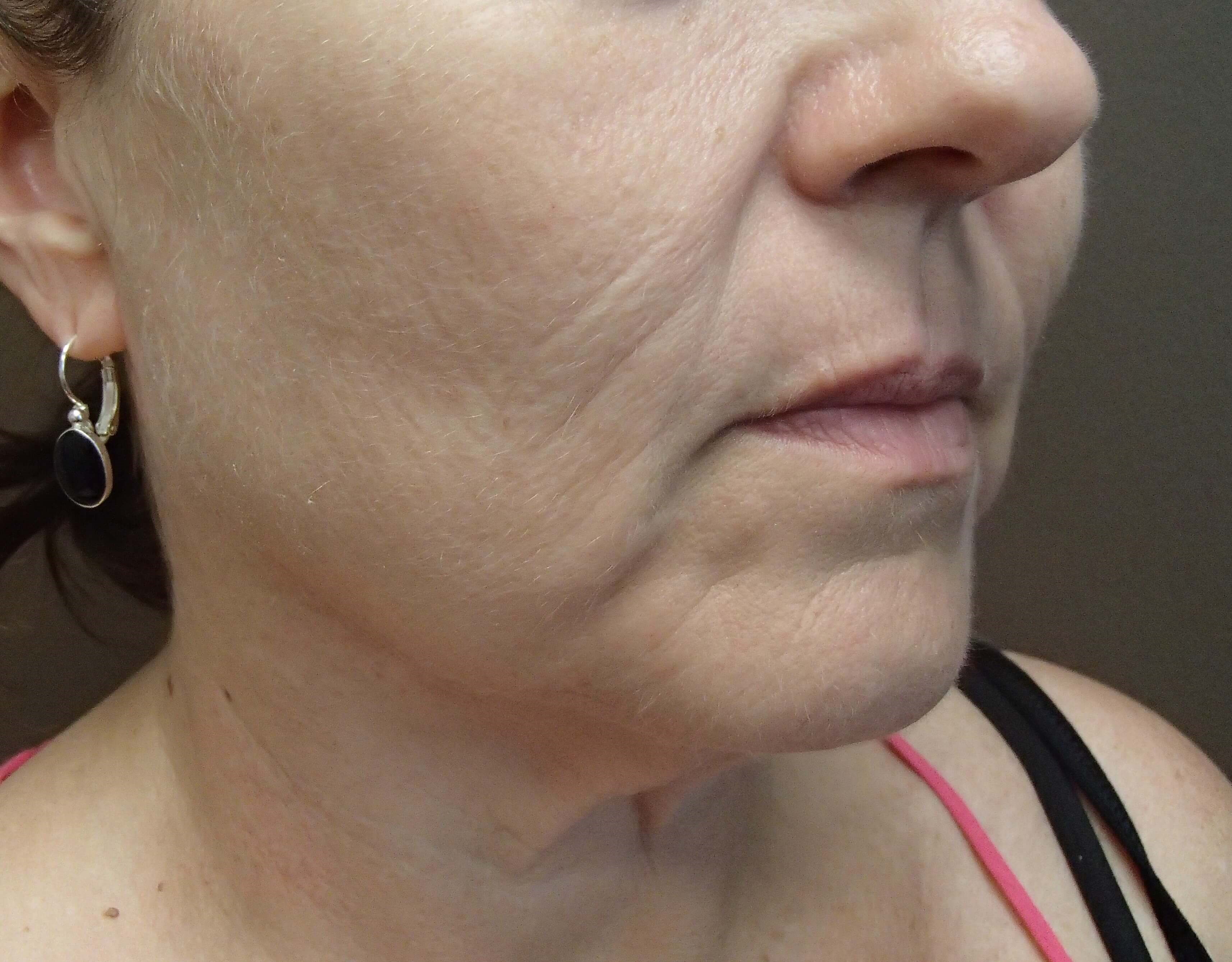 Necklift Before