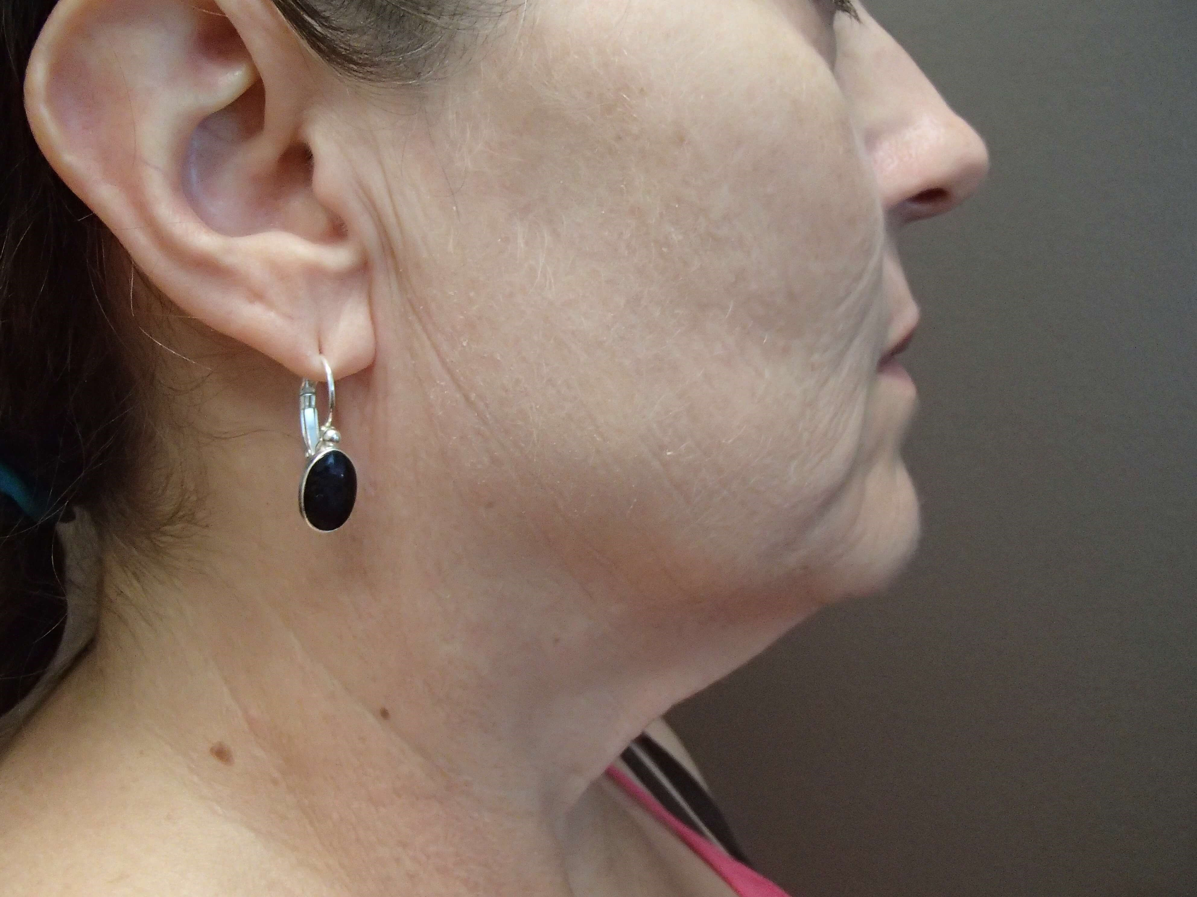 Necklift Before