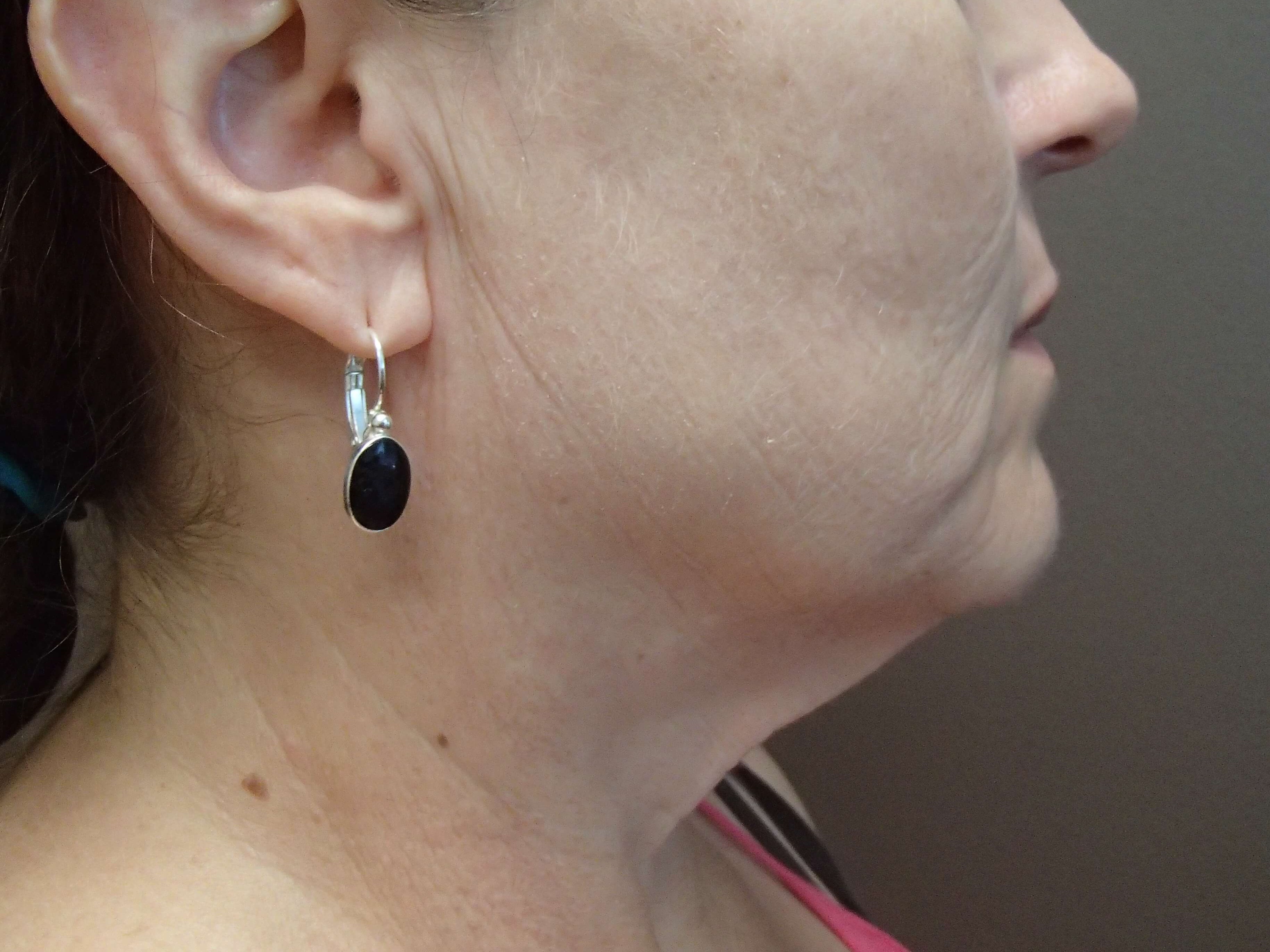 Necklift Before