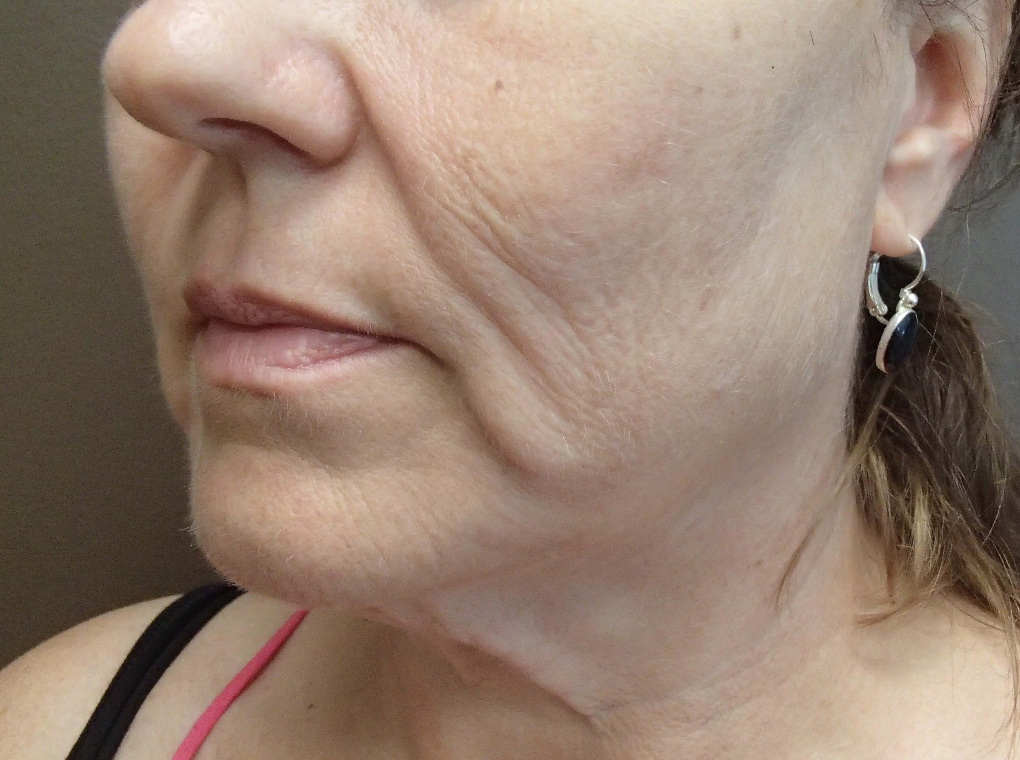 Necklift Before
