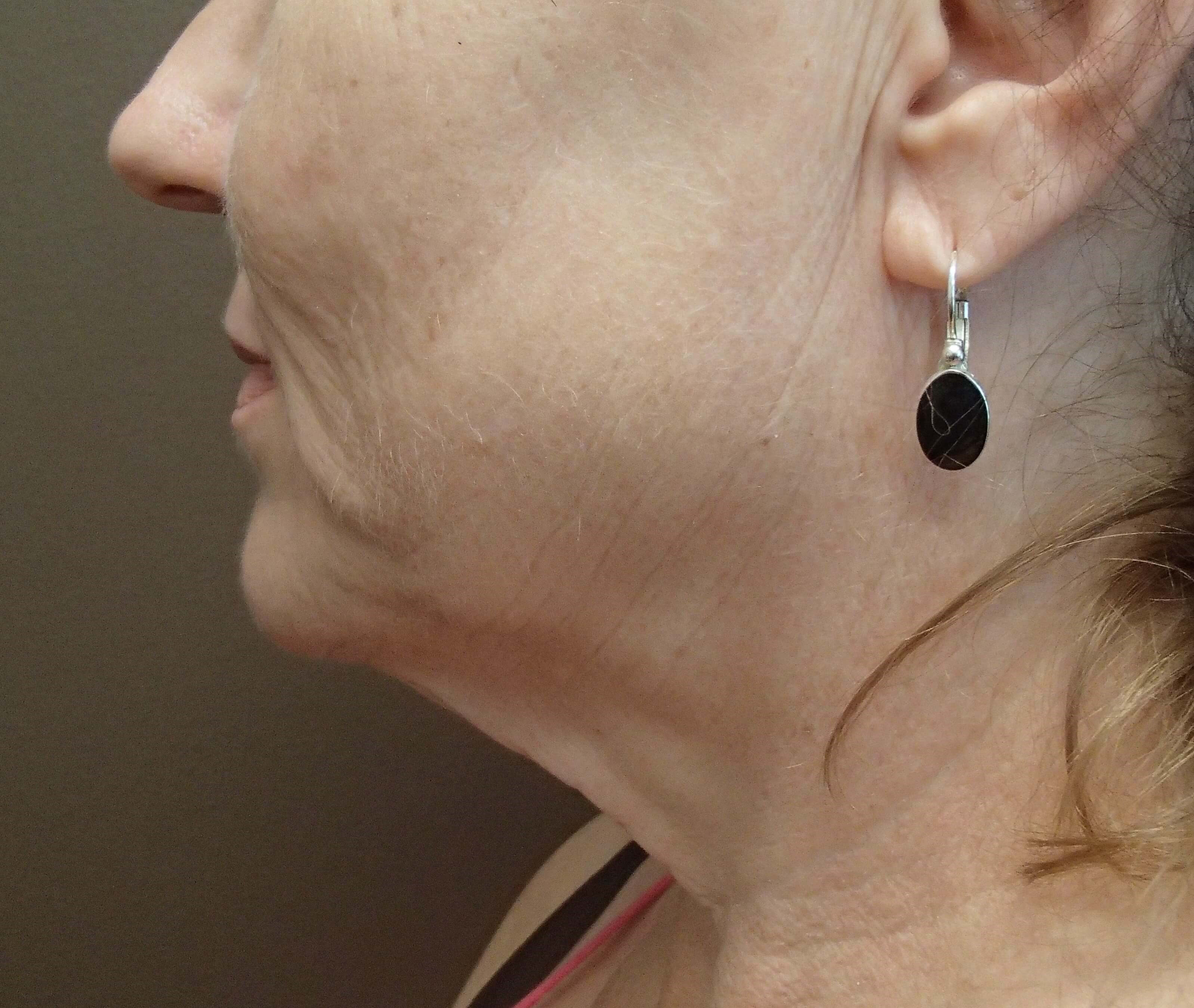 Necklift Before