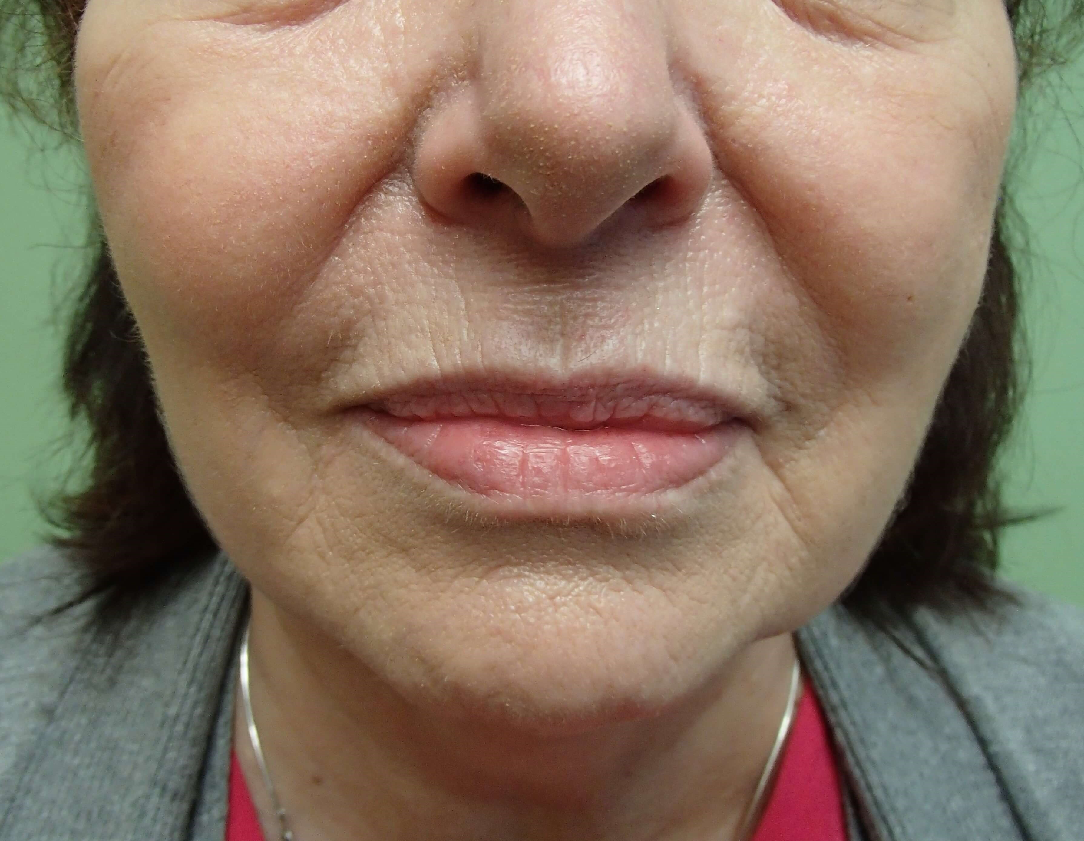 Necklift Before
