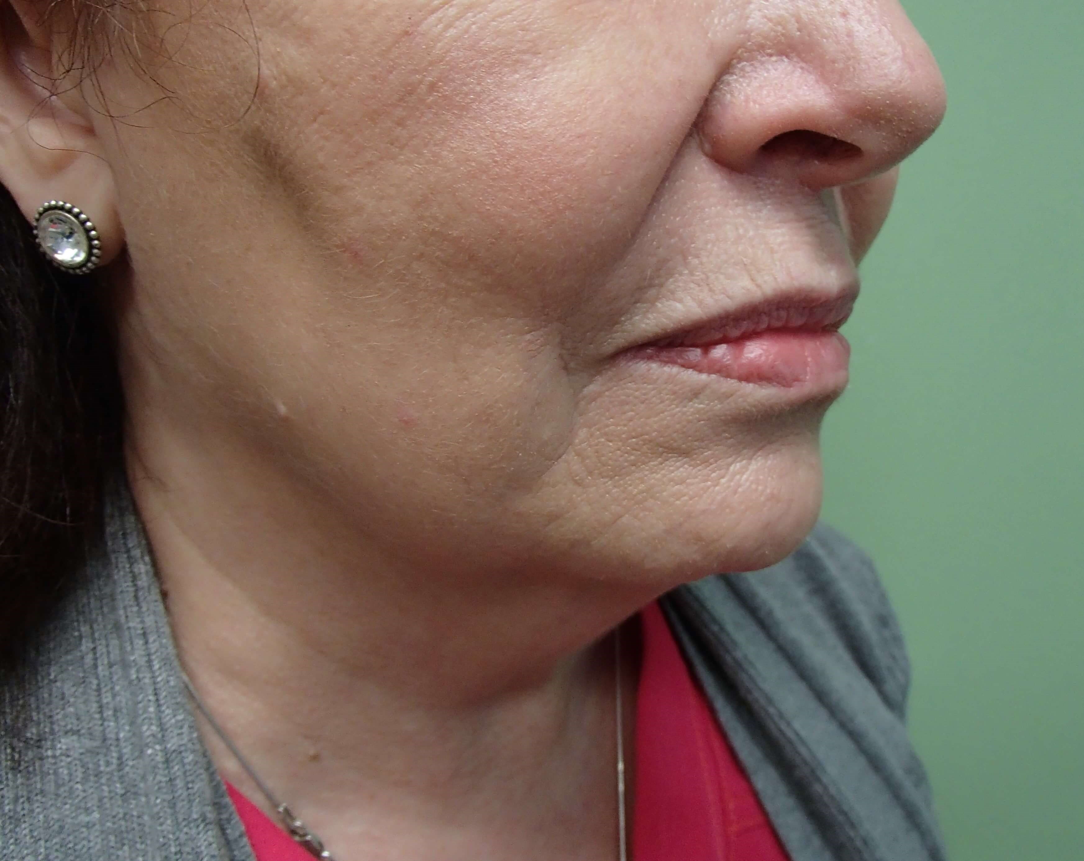 Necklift Before