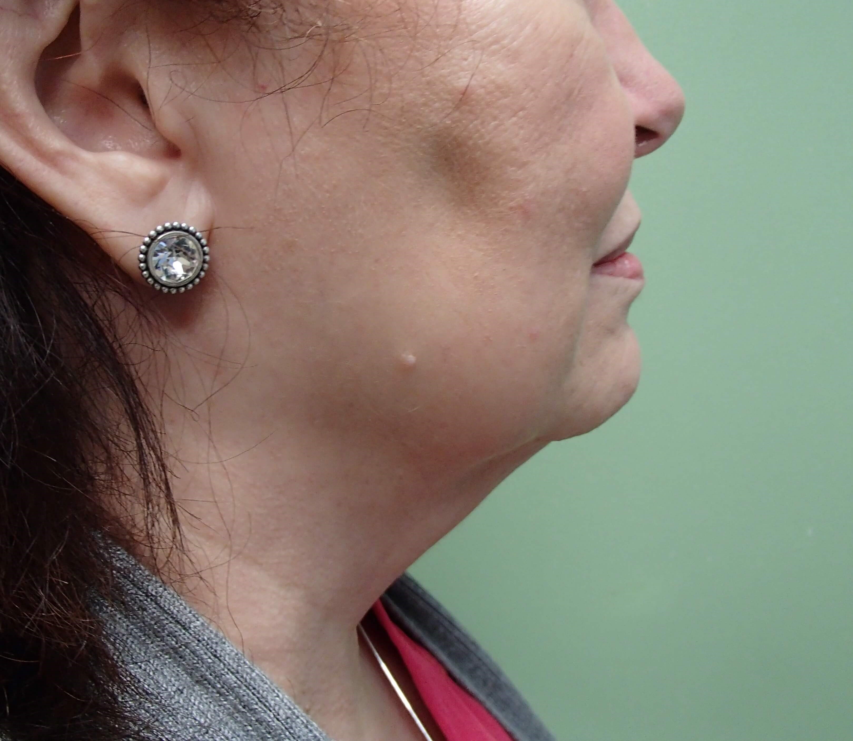 Necklift Before