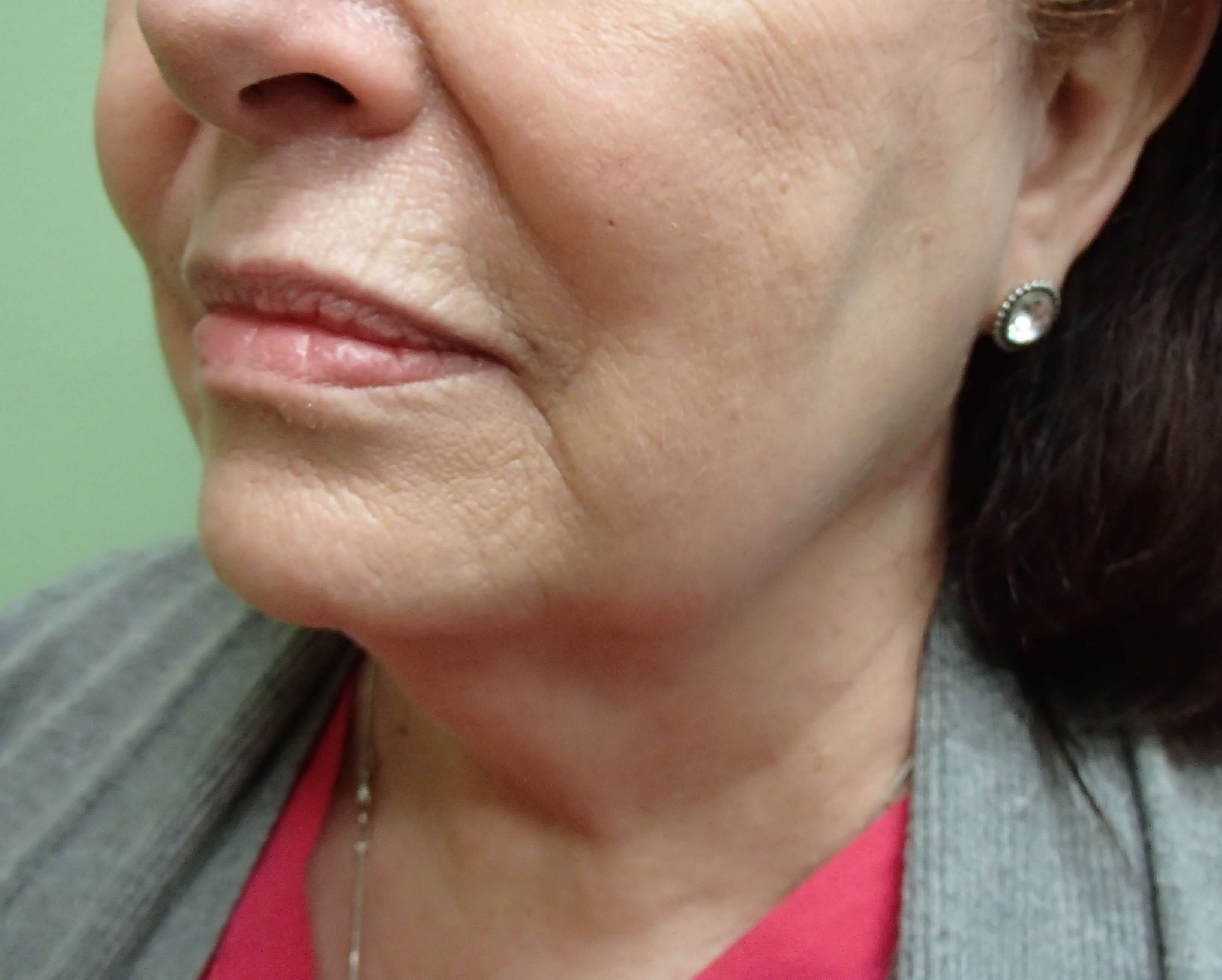 Necklift Before