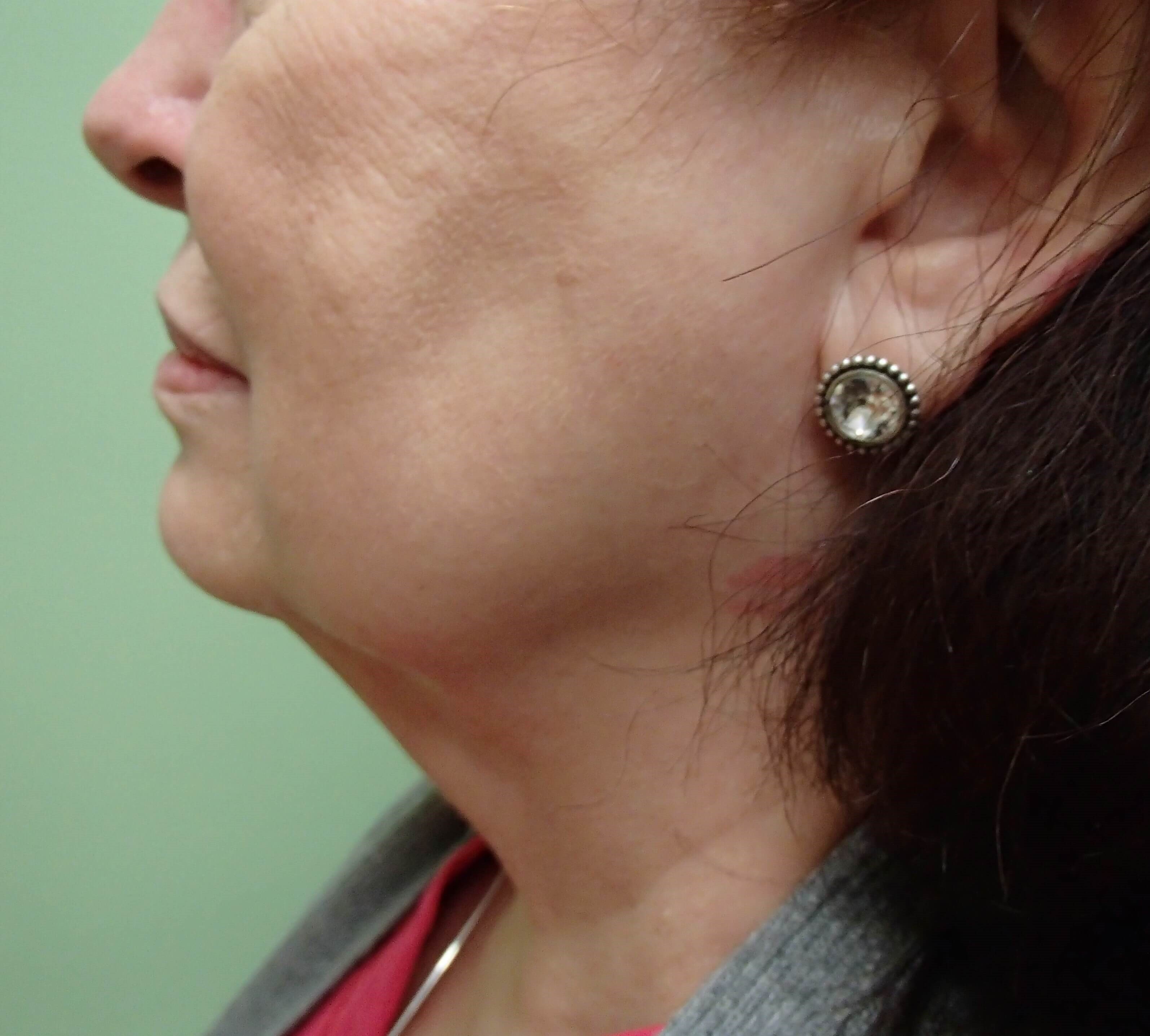 Necklift Before