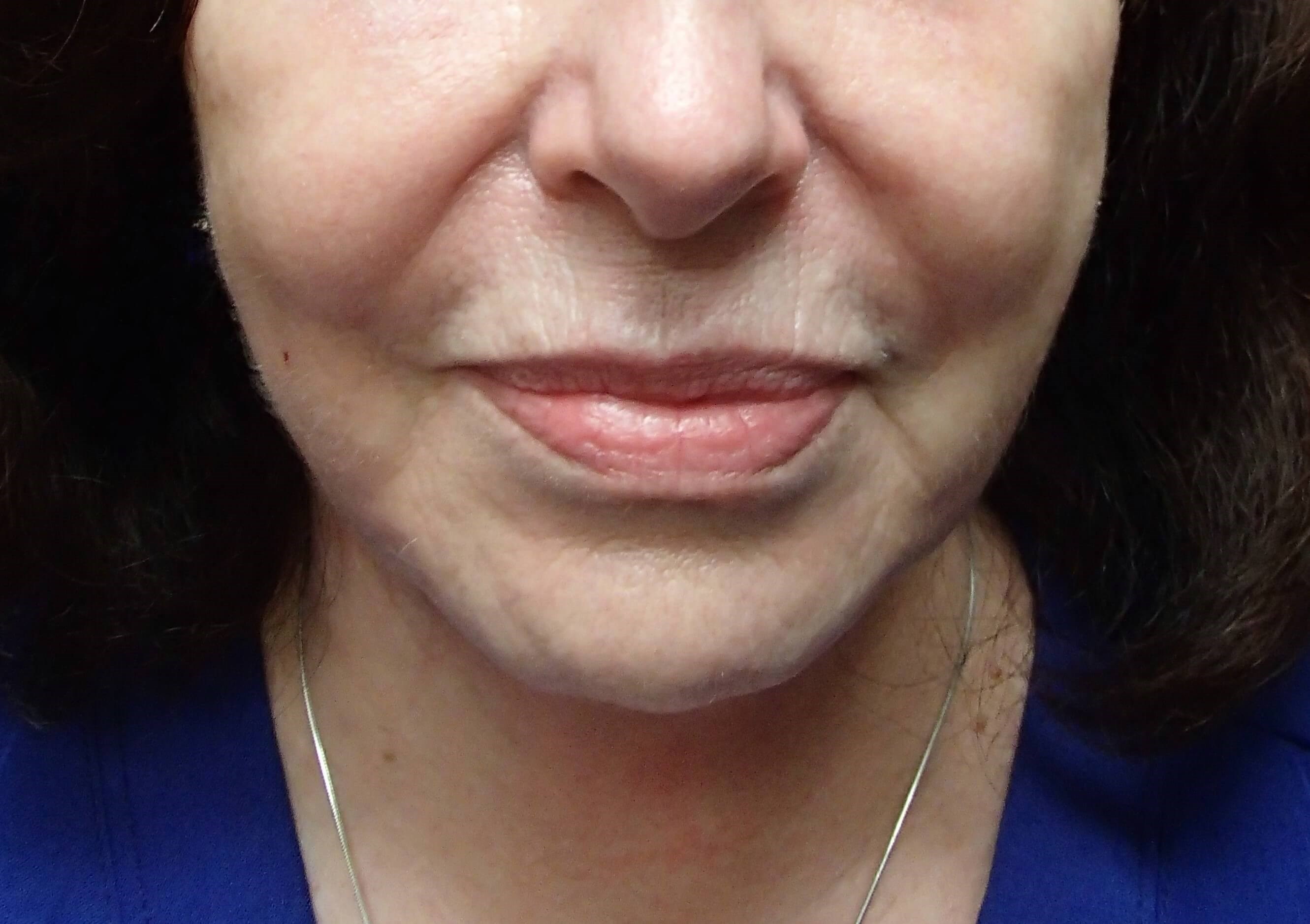 Necklift After