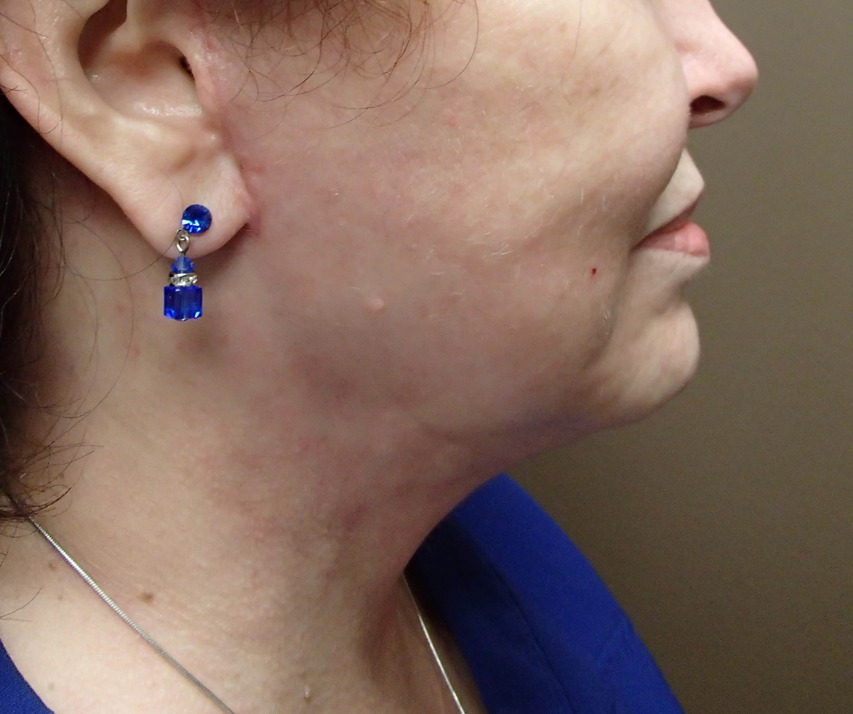 Necklift After