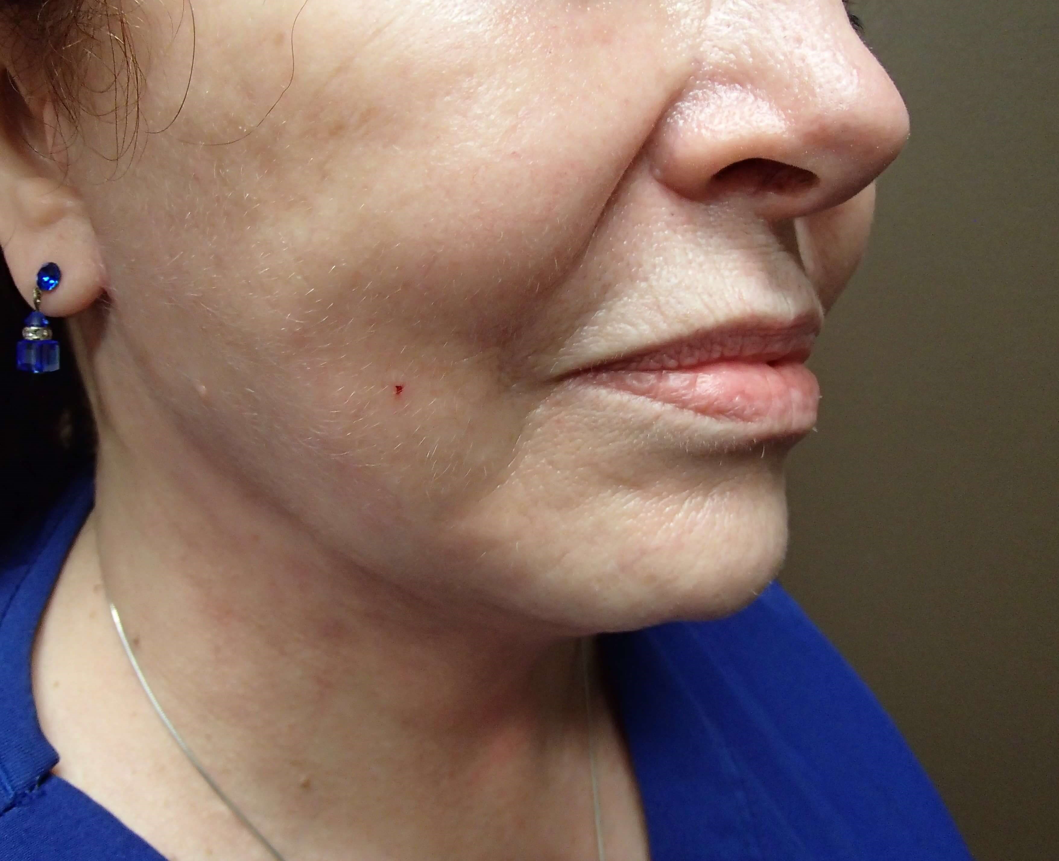 Necklift After