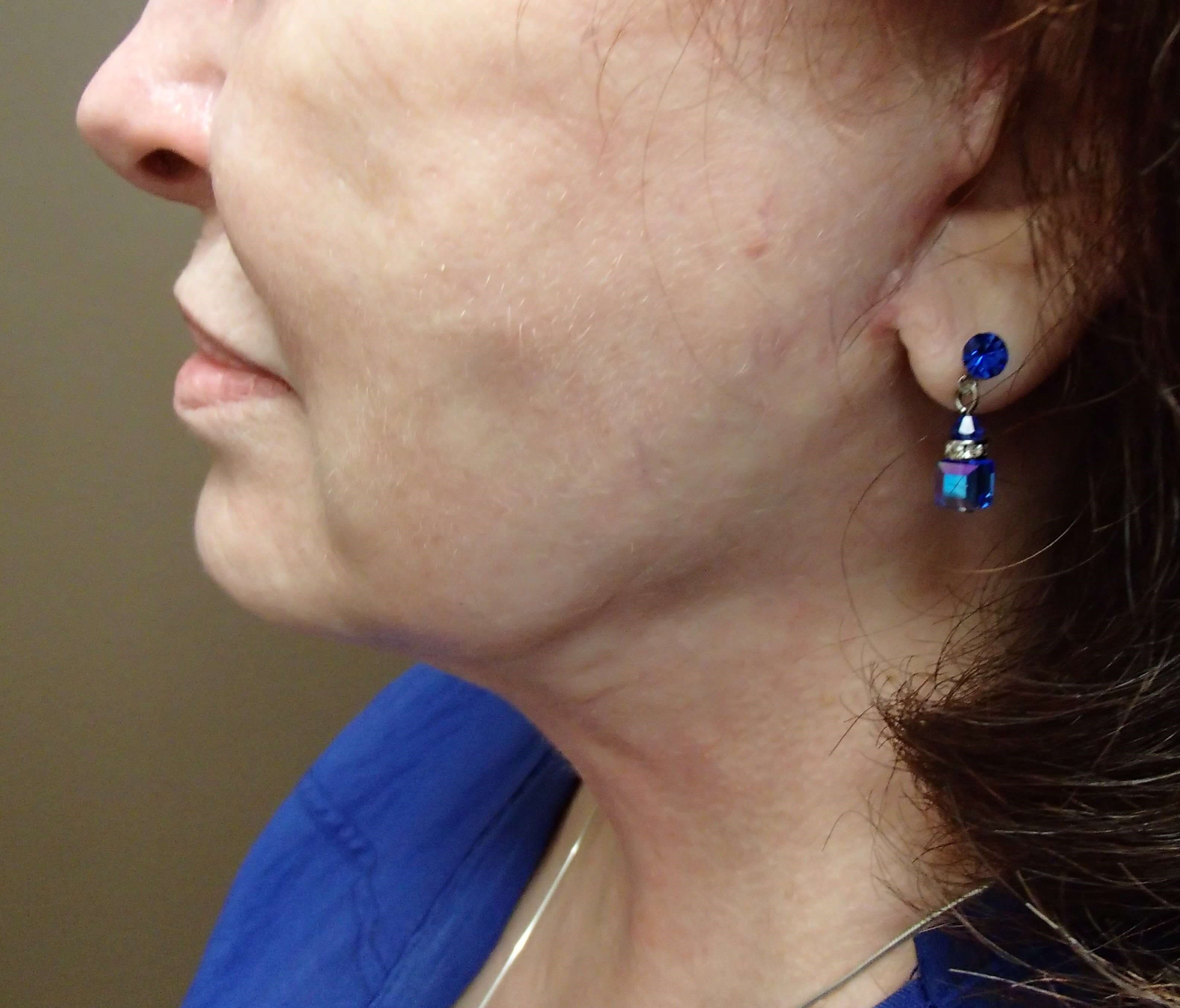 Necklift After