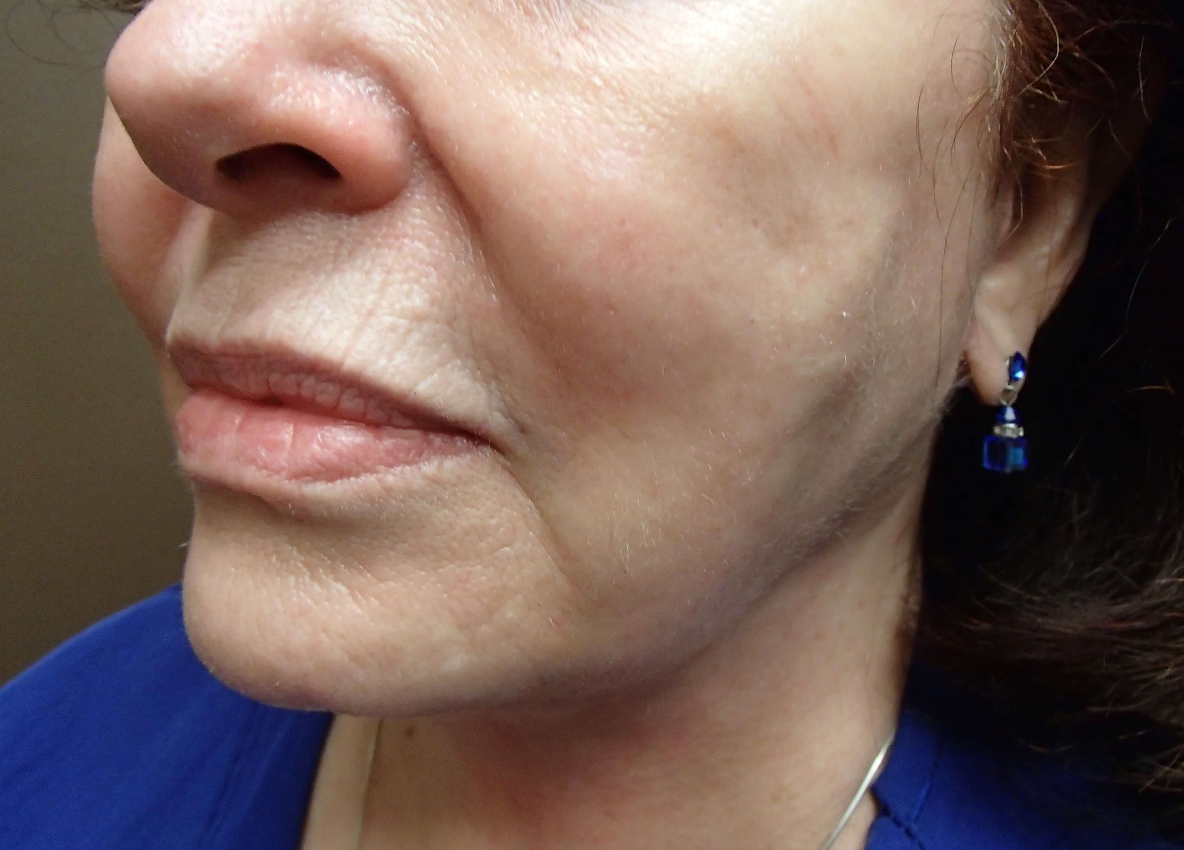 Necklift After