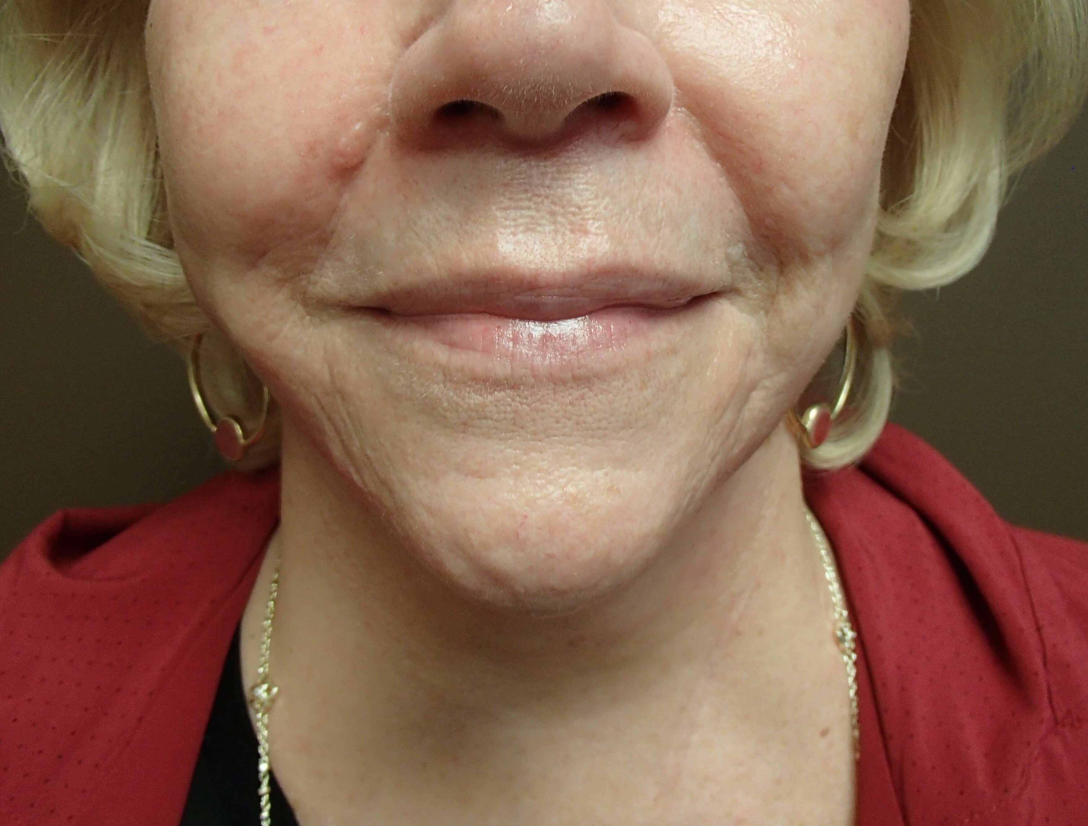 Necklift After