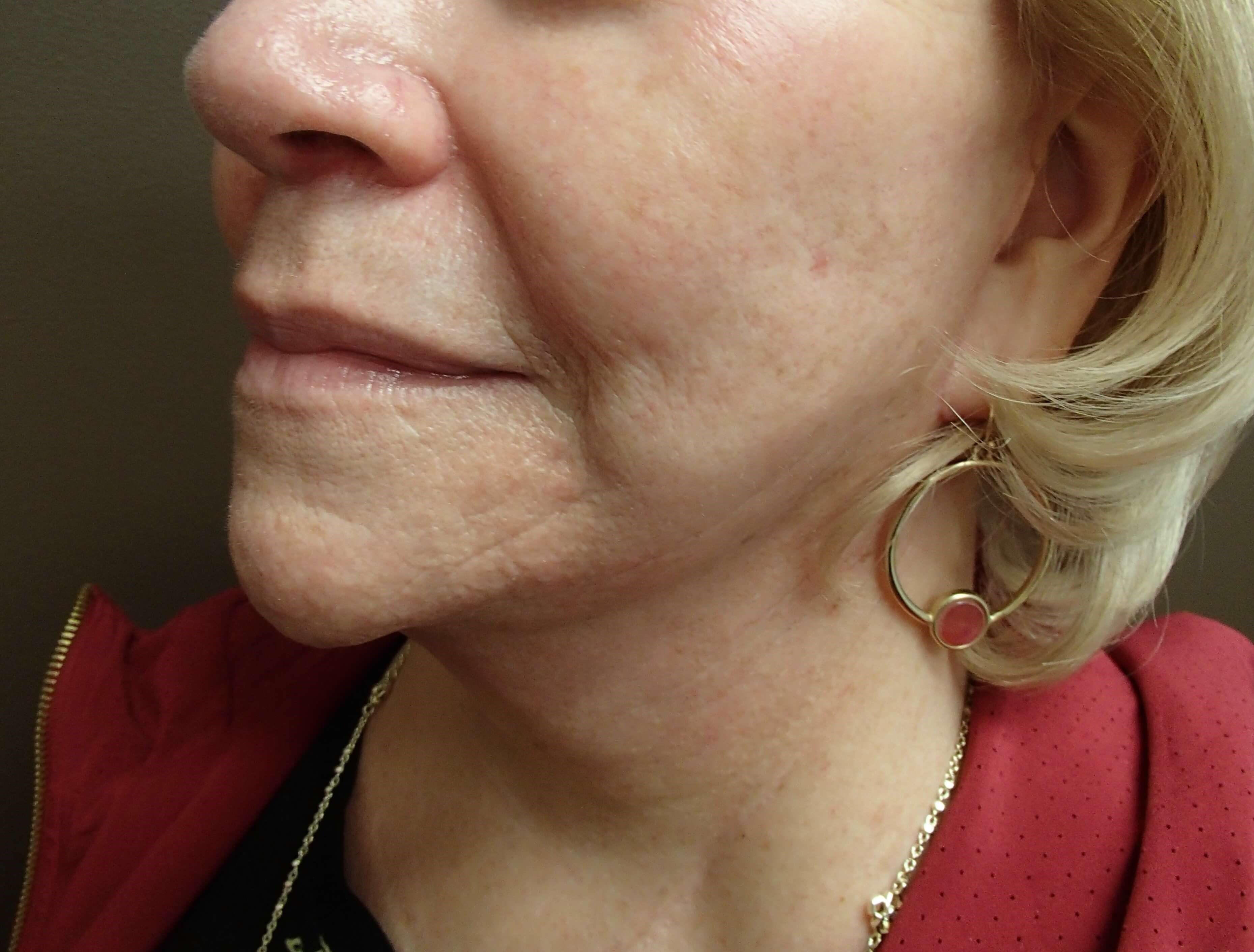 Necklift After