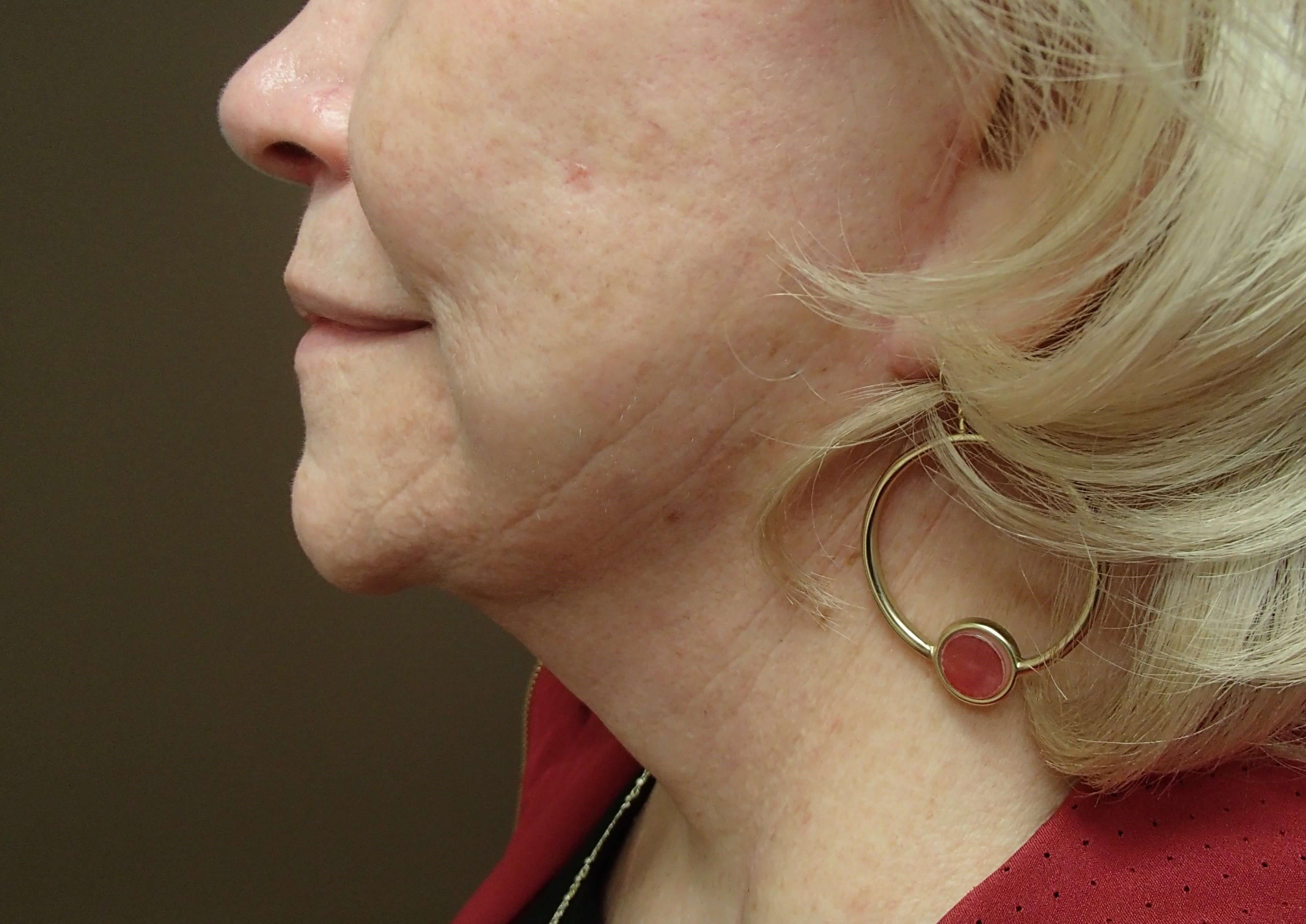 Necklift After