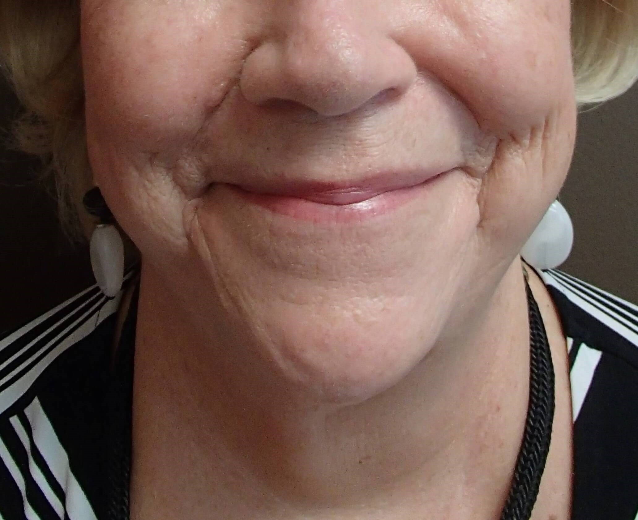 Necklift Before