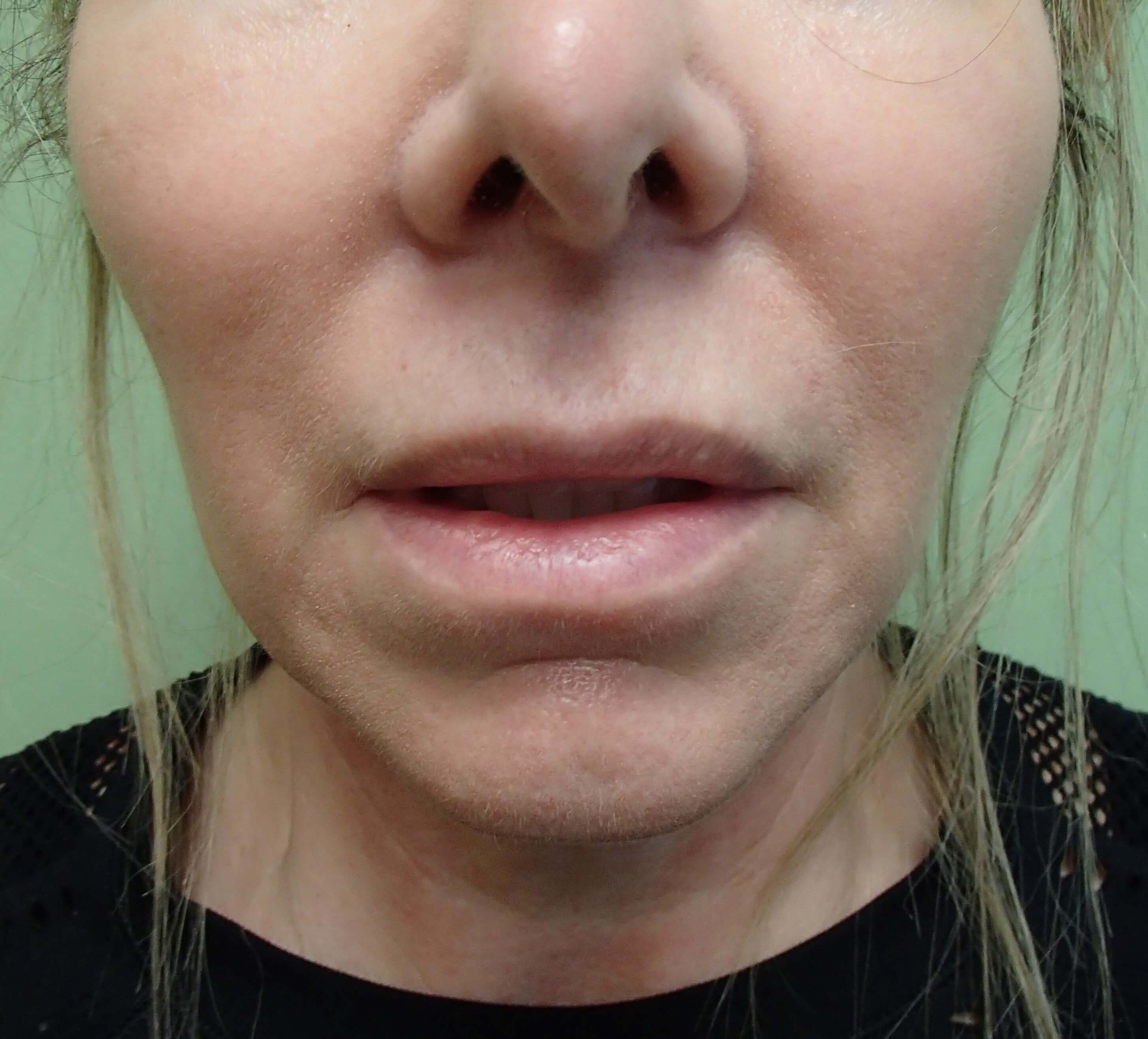 Necklift Before