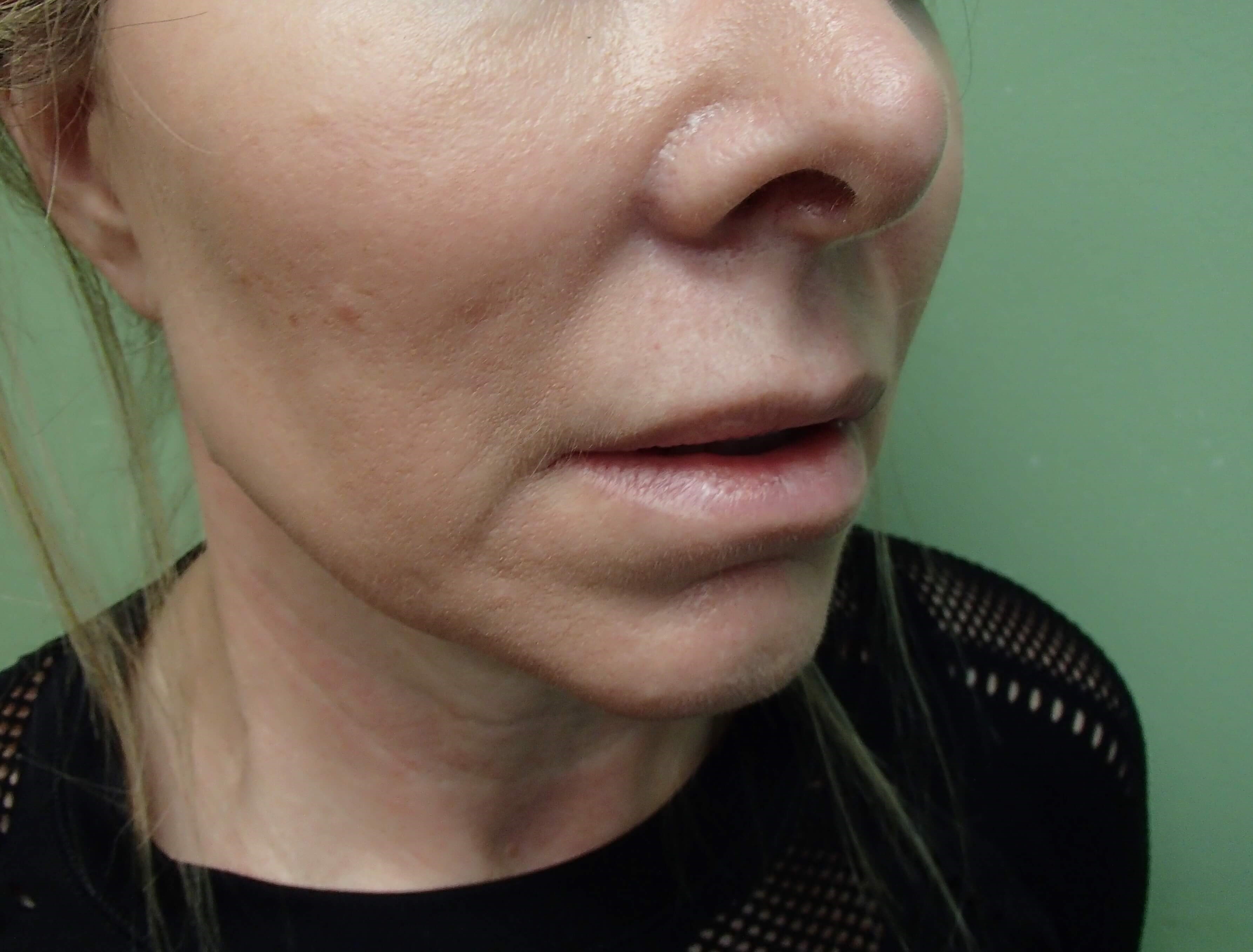 Necklift Before