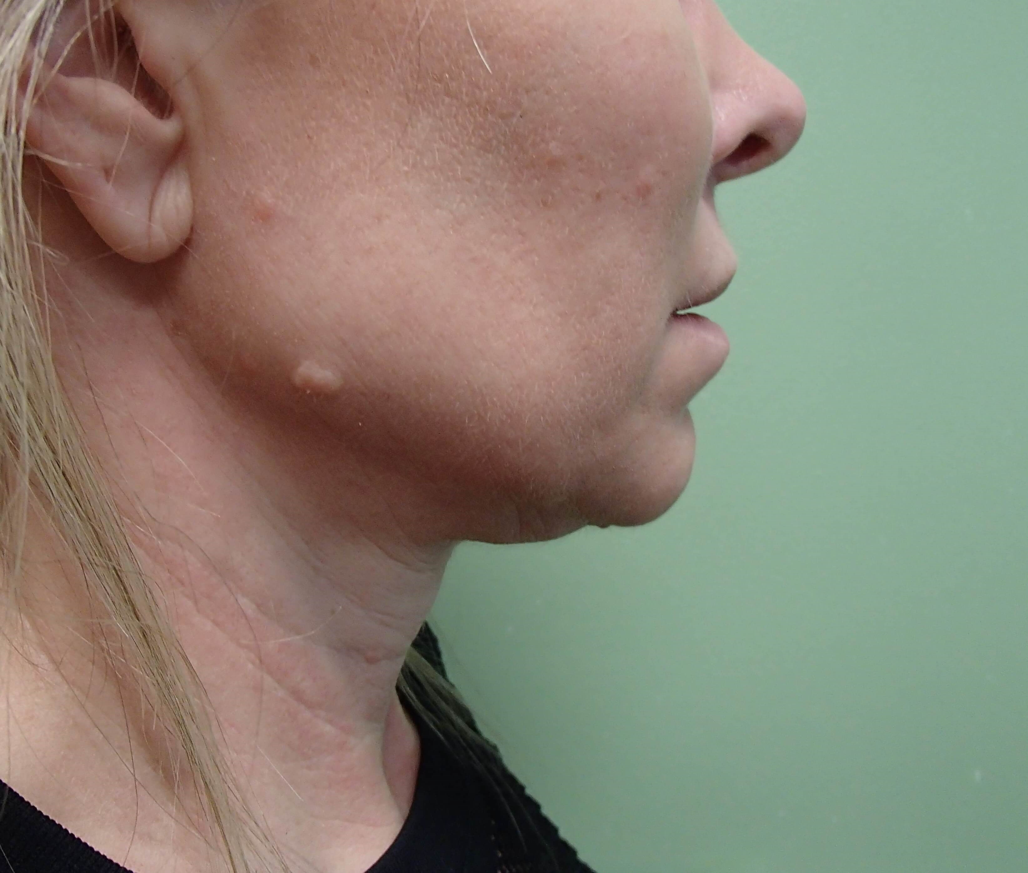 Necklift Before