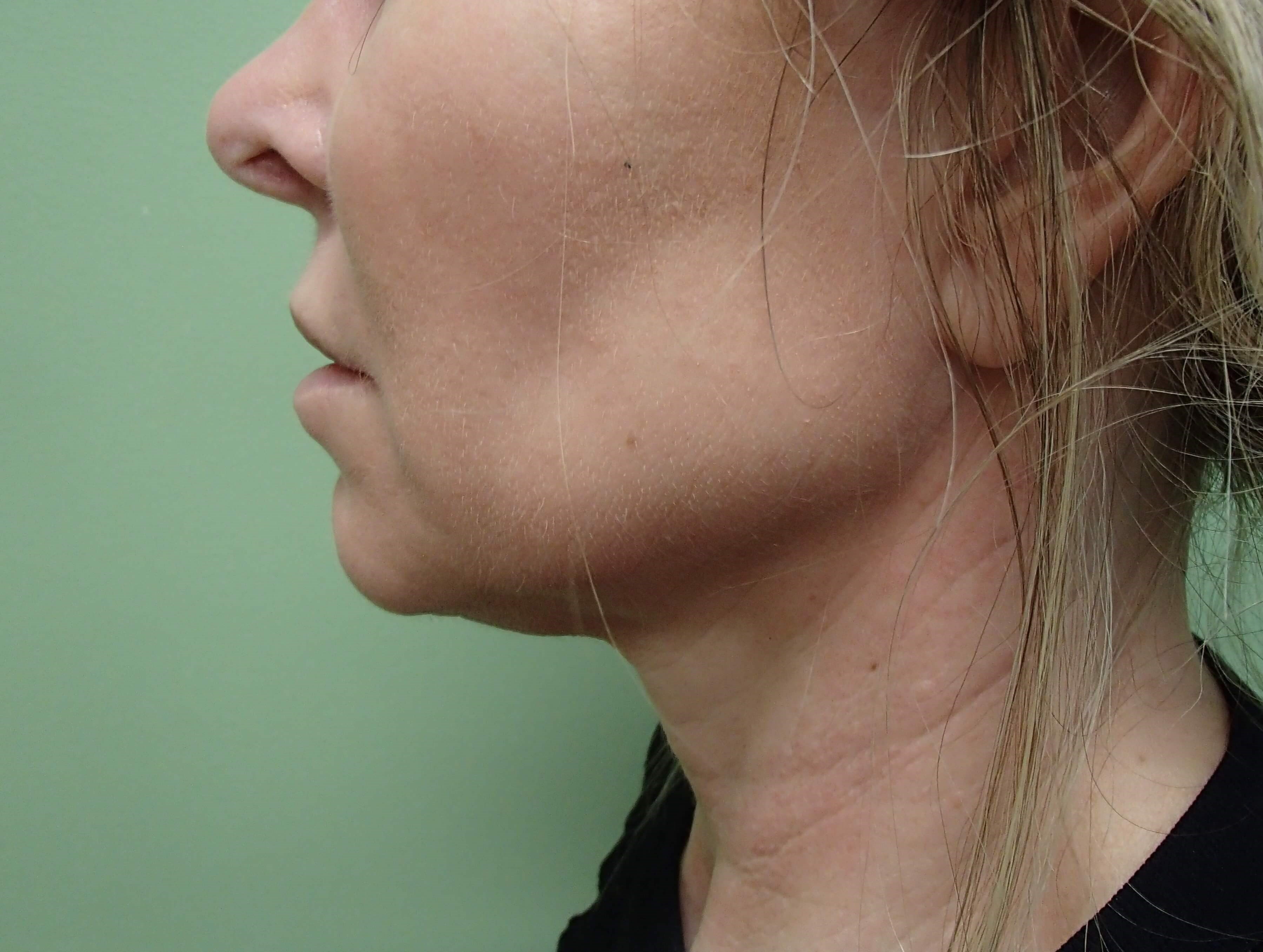 Necklift Before