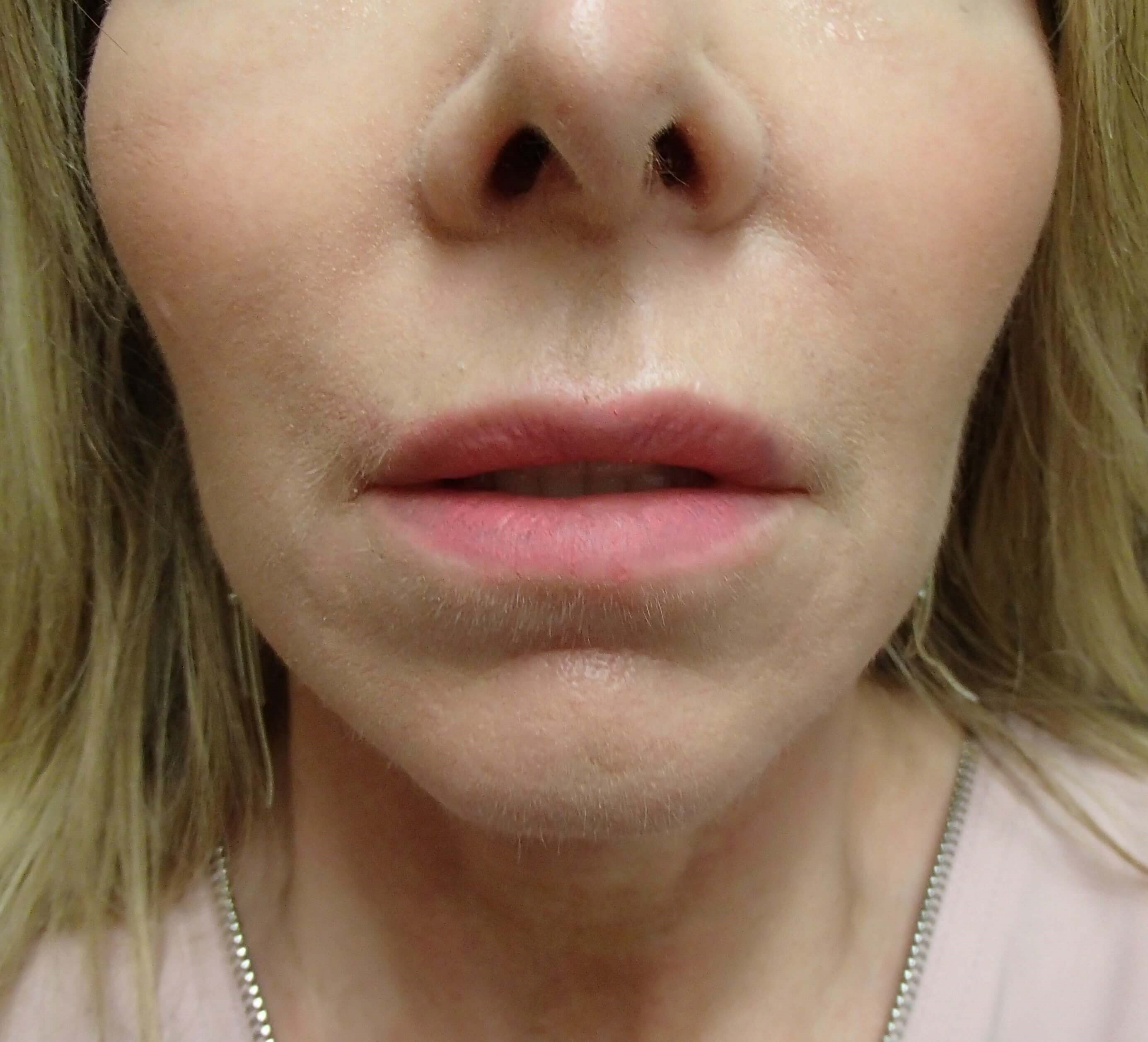 Necklift After