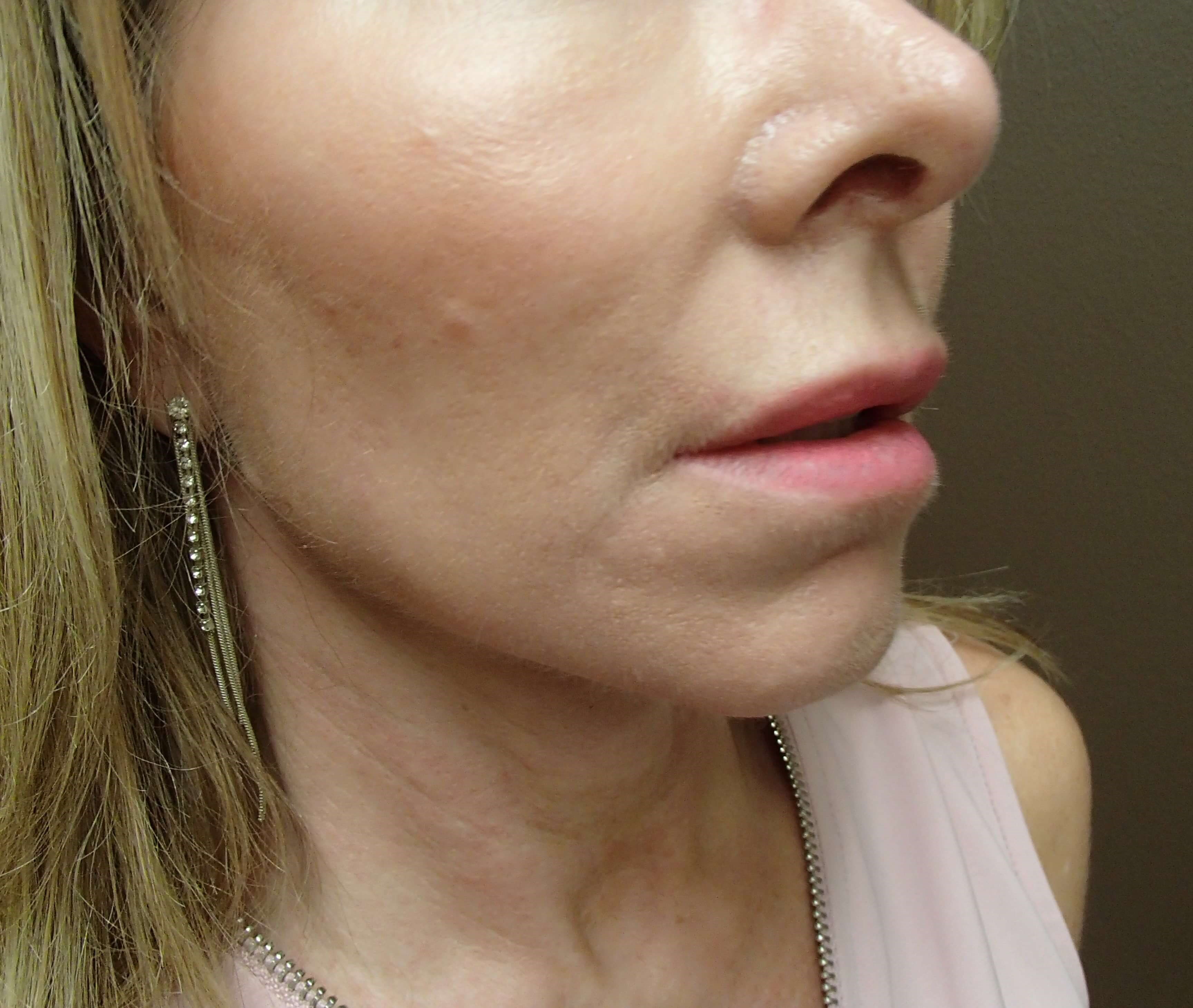 Necklift After