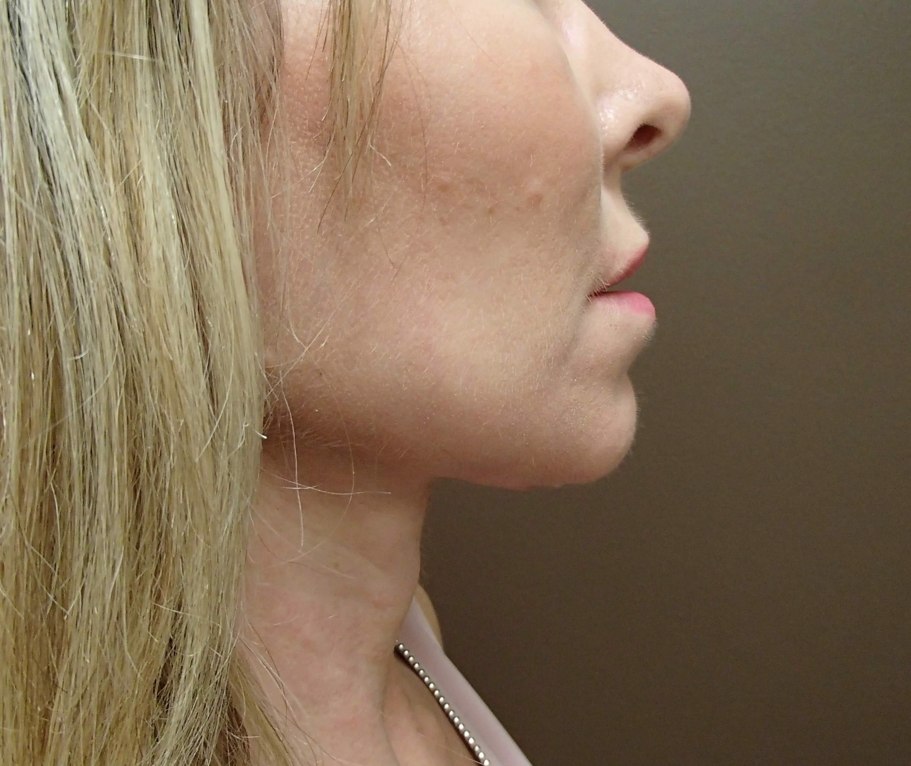 Necklift After