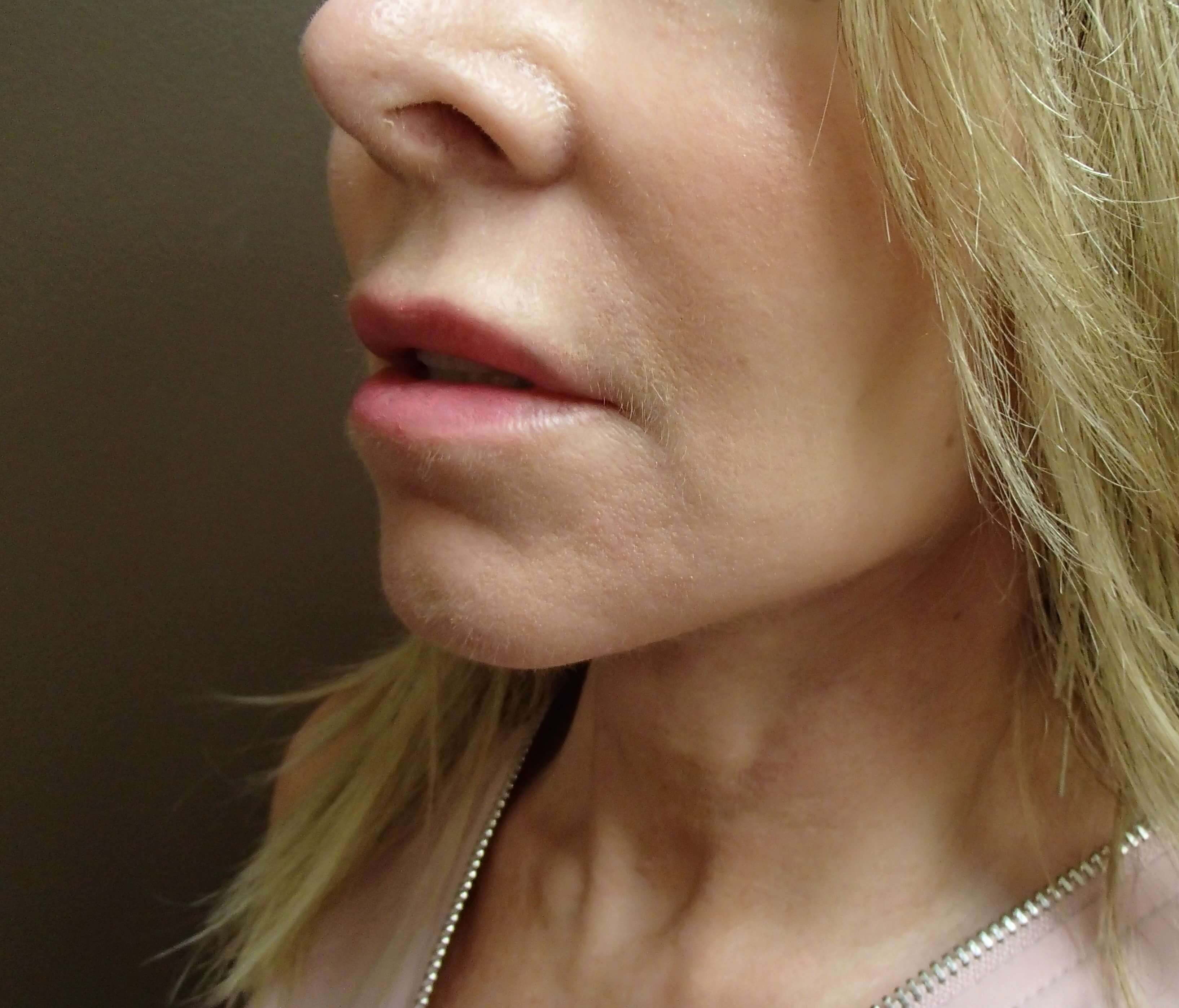 Necklift After