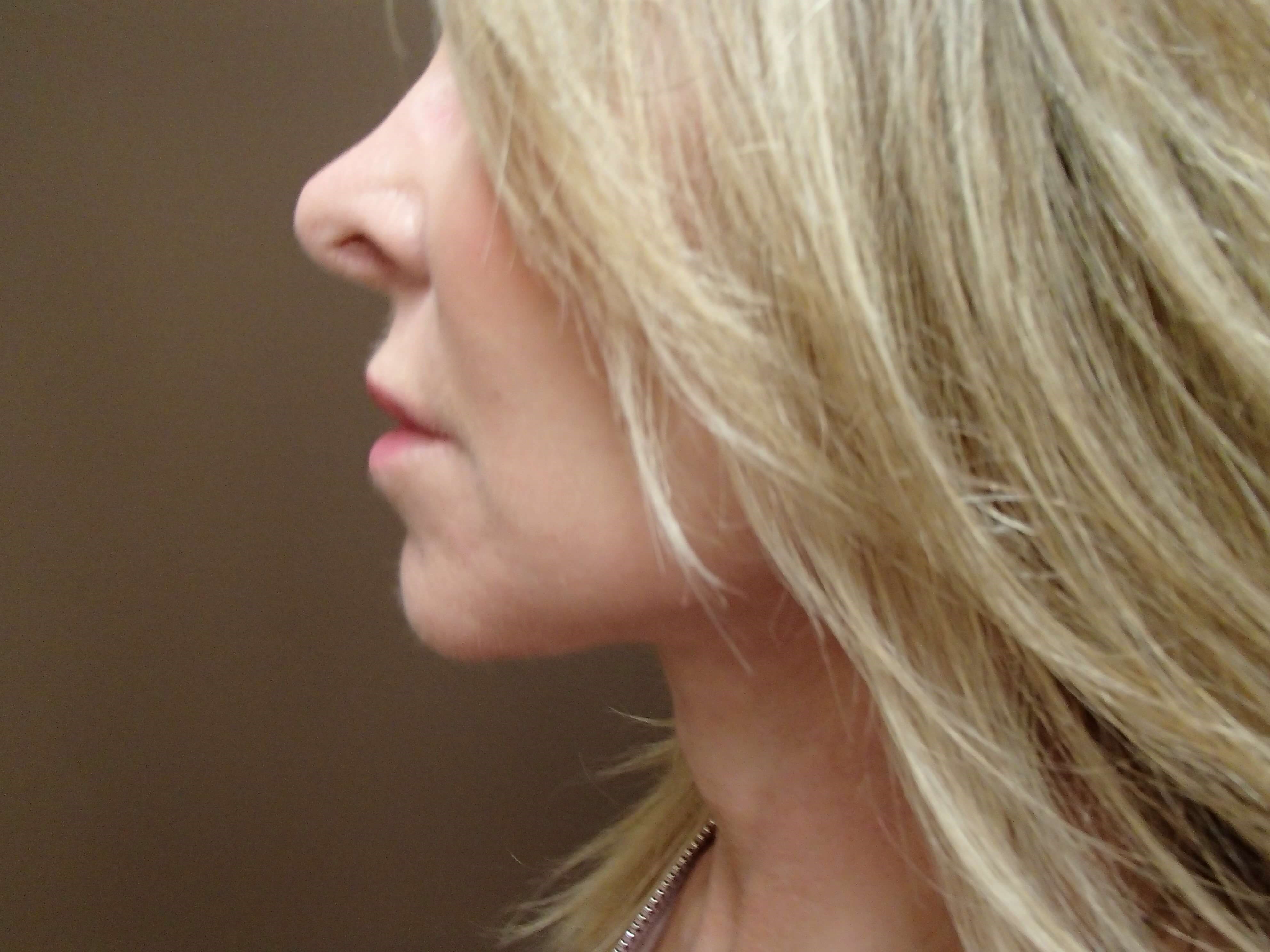 Necklift After