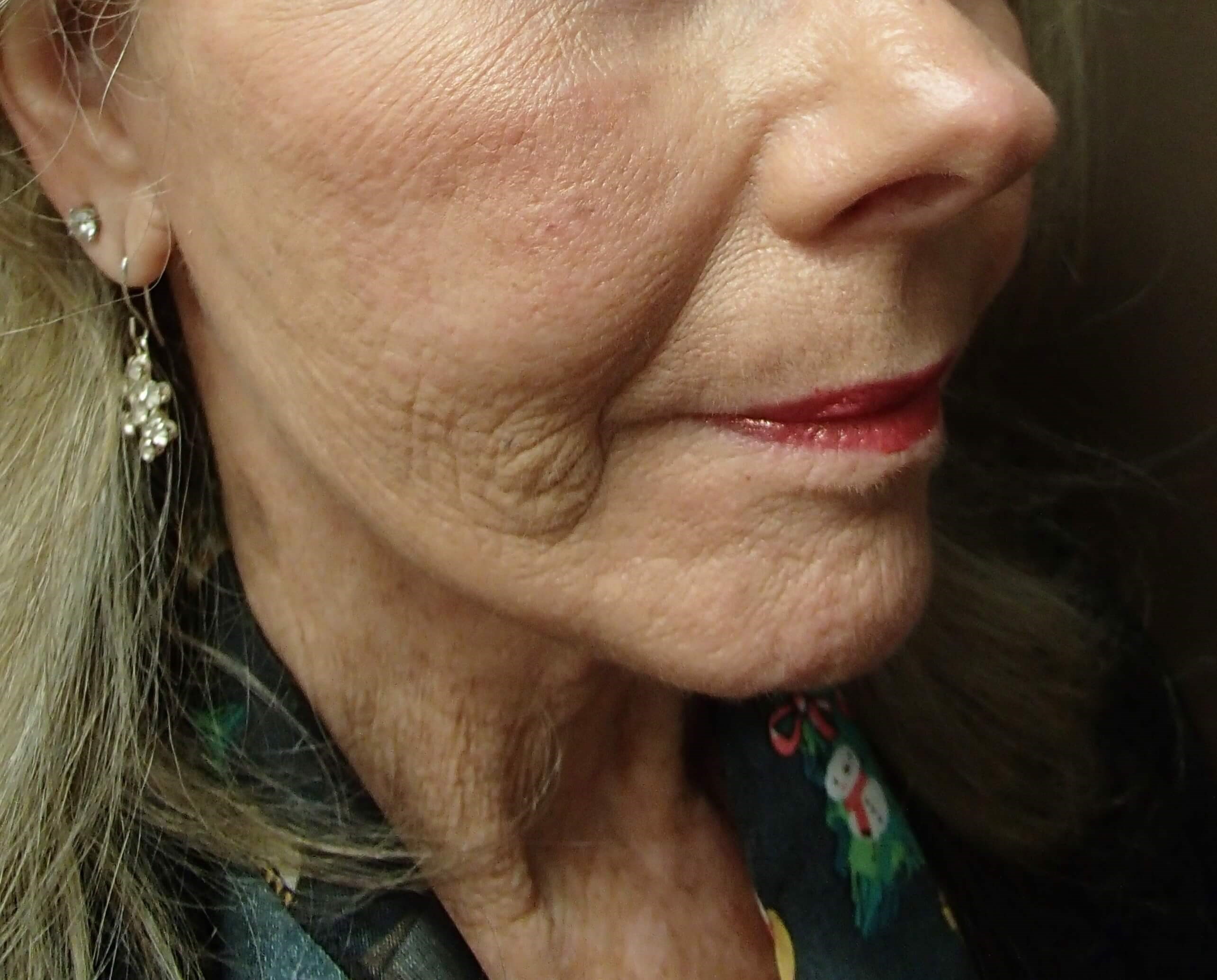 Necklift After