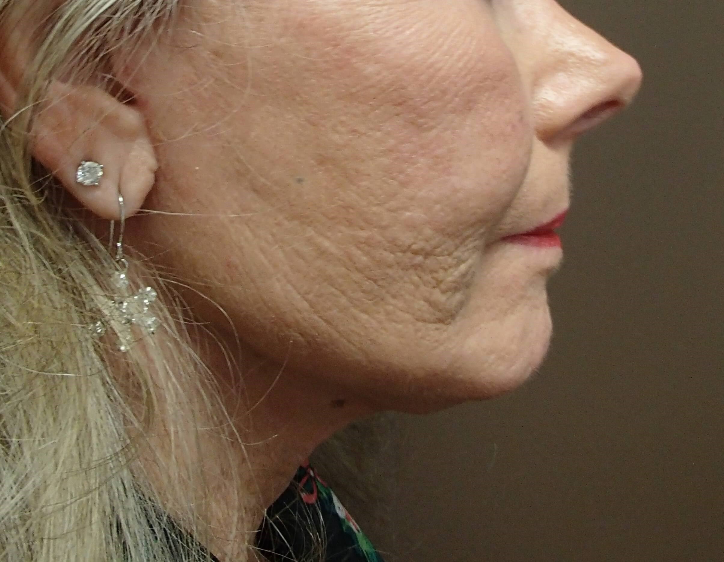Necklift After