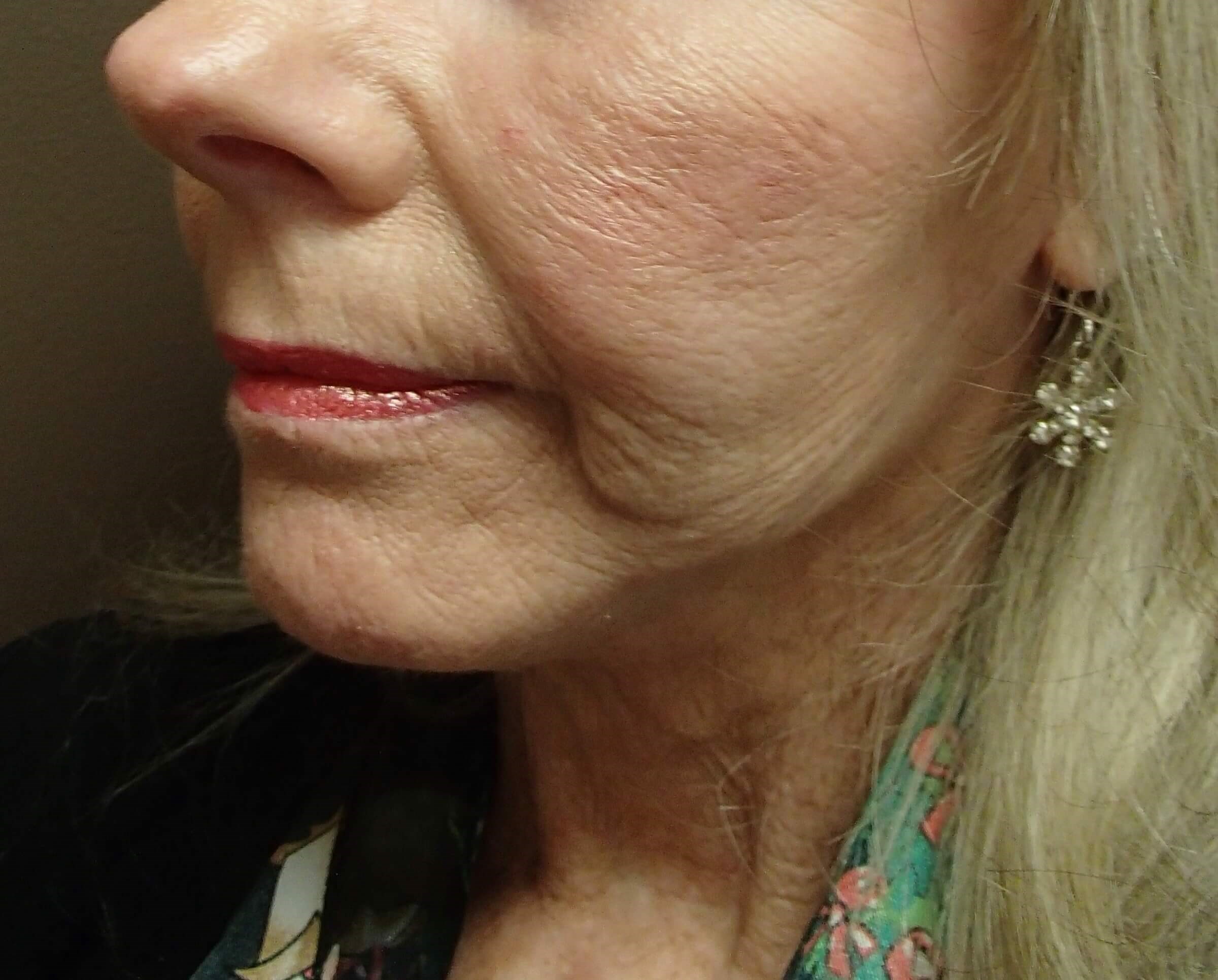 Necklift After