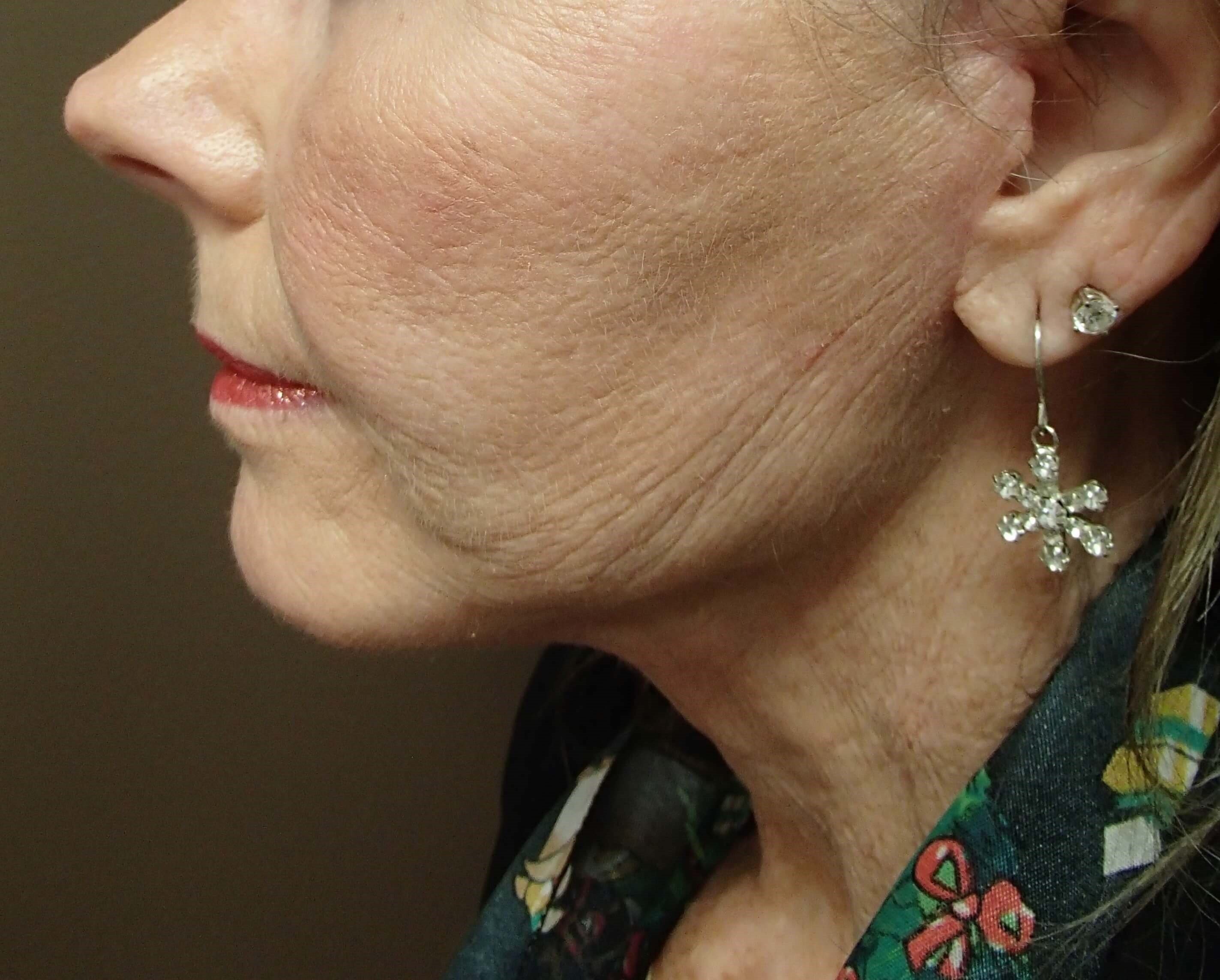 Necklift After