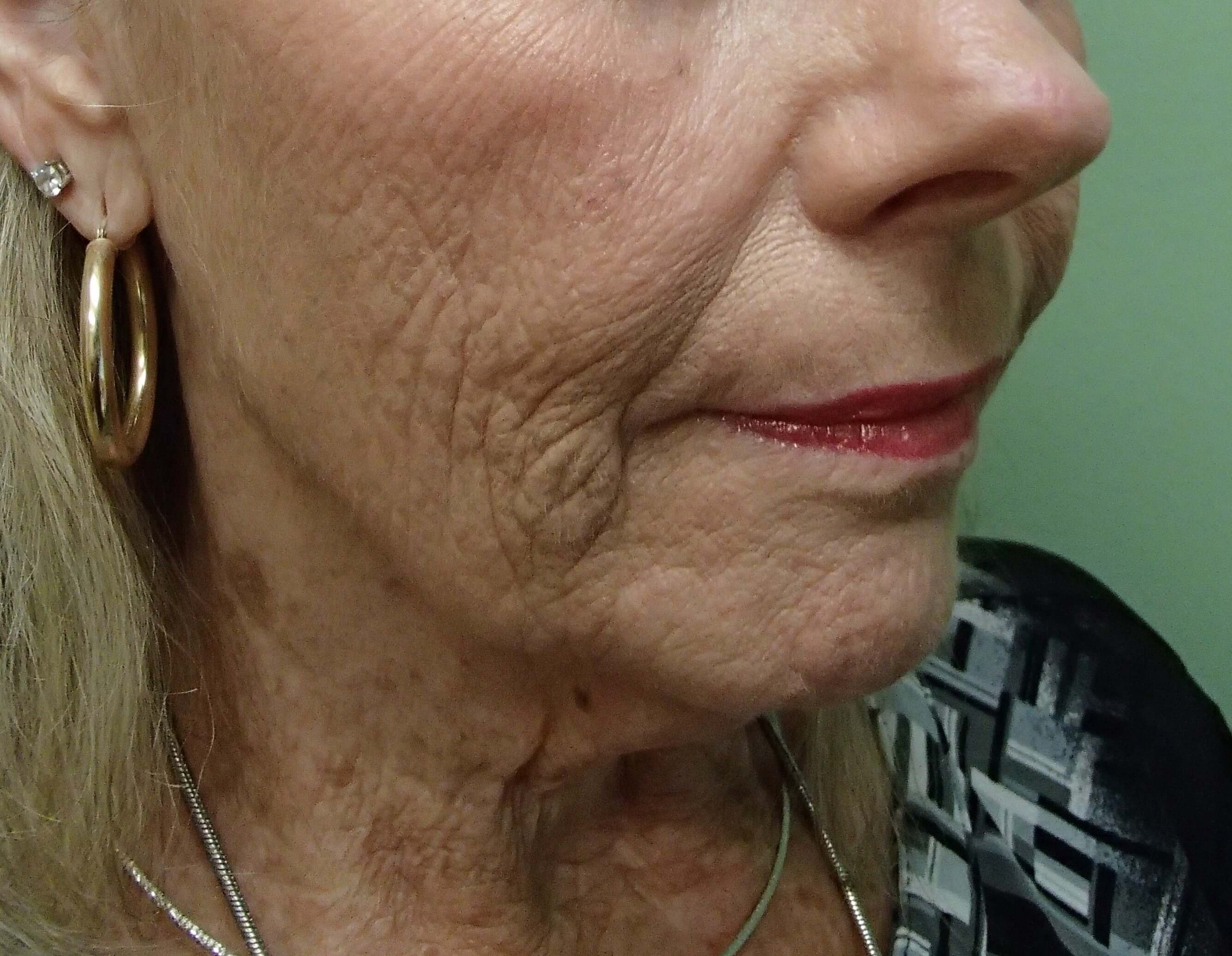 Necklift Before