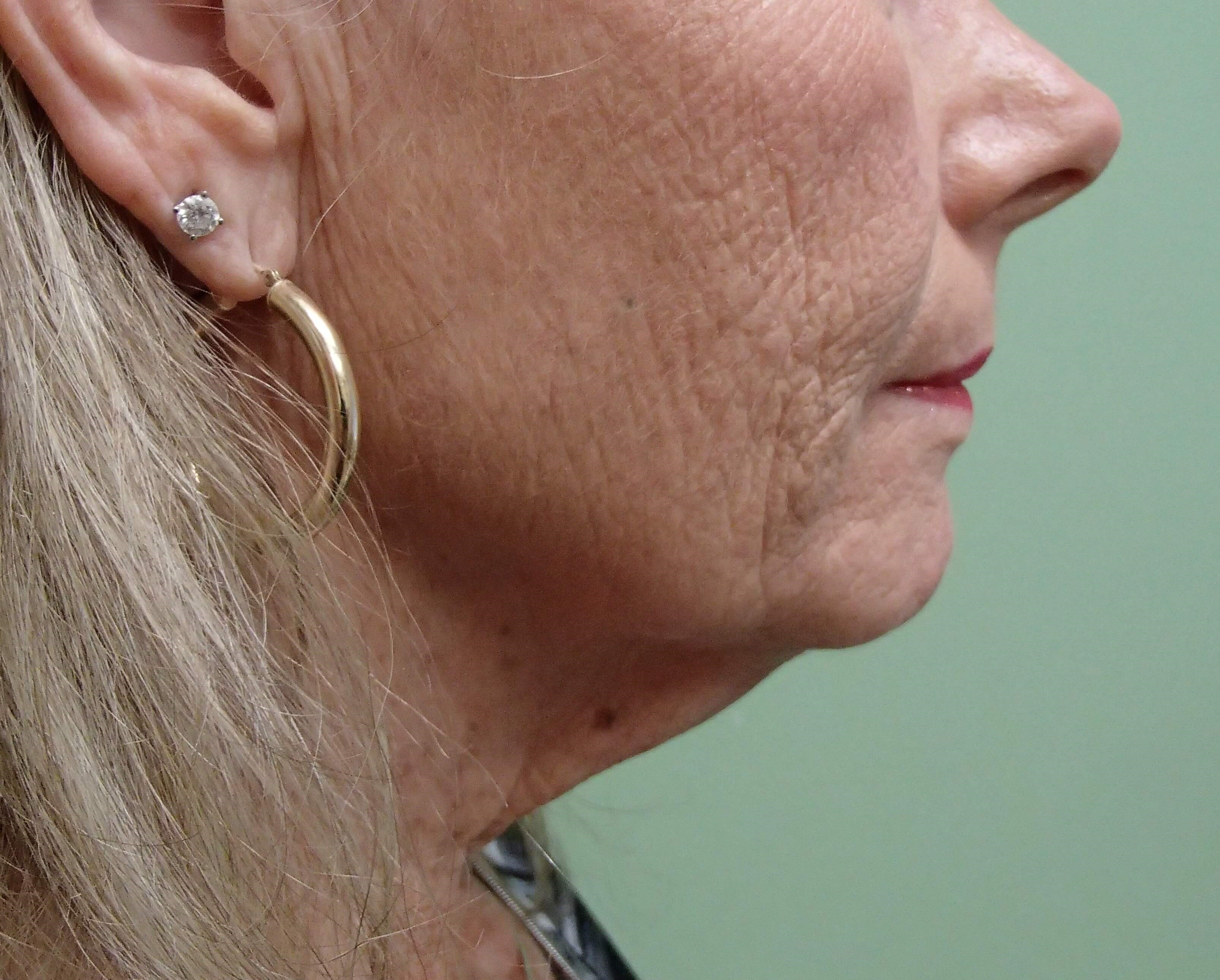 Necklift Before