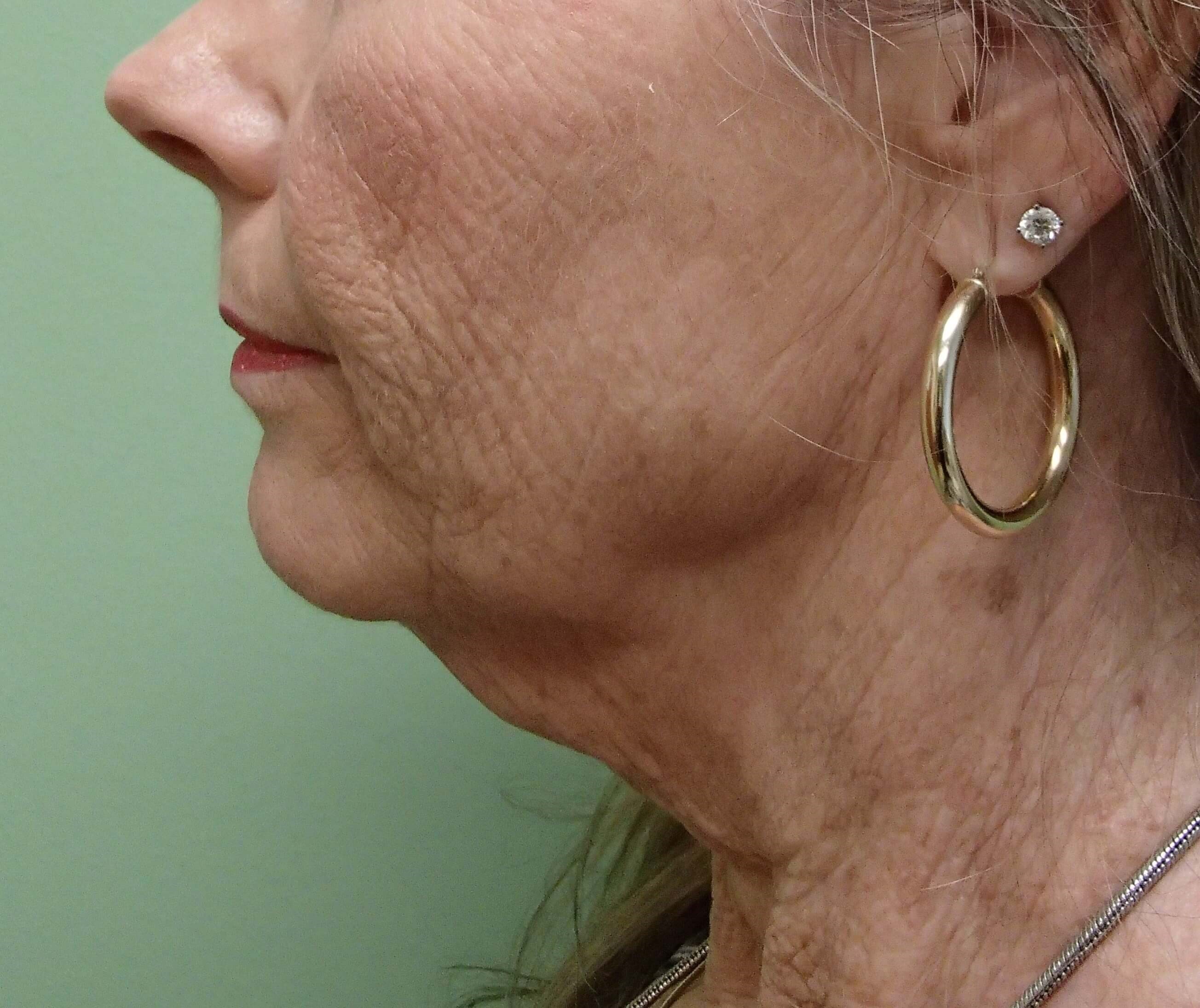 Necklift Before